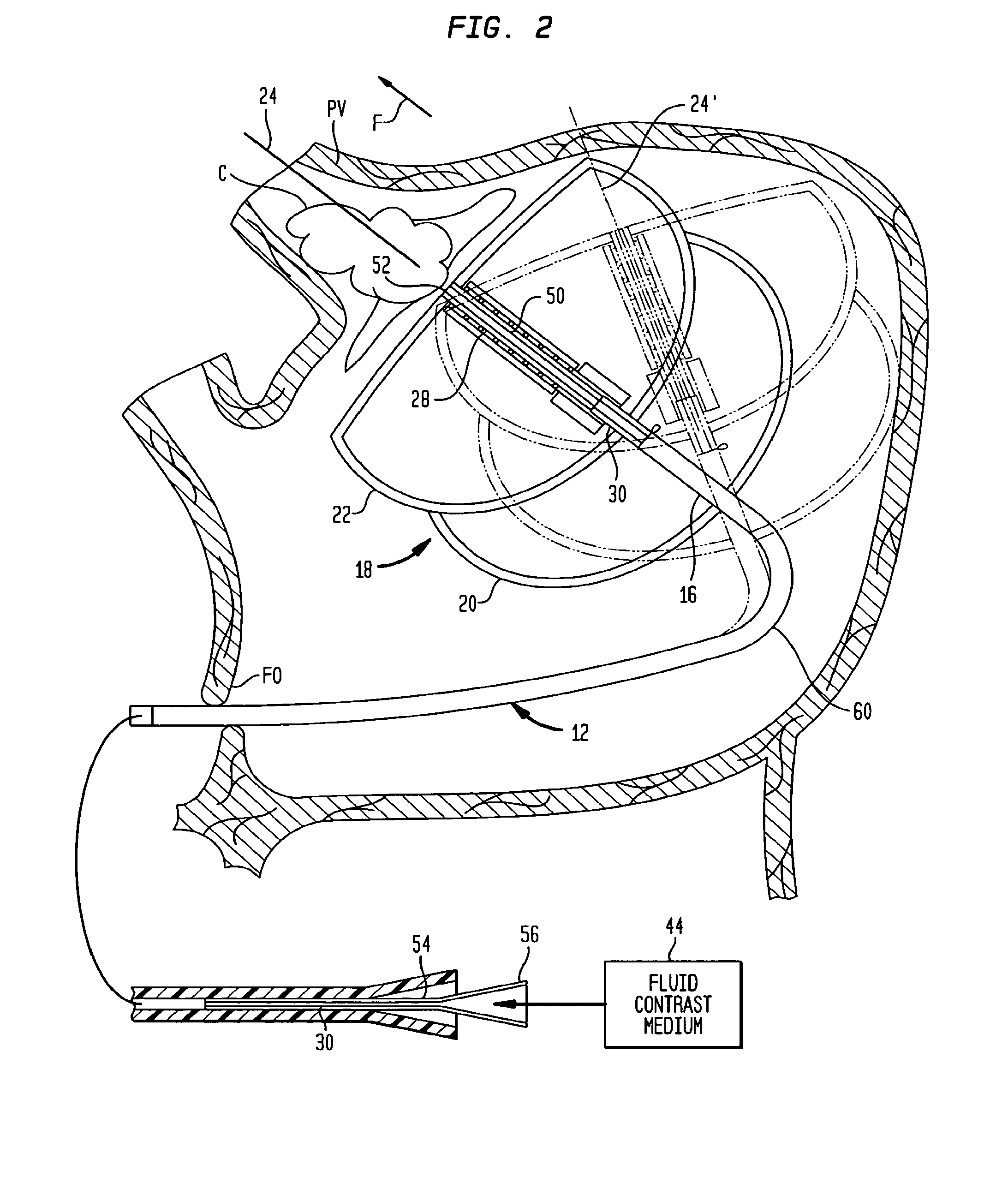 Cardiac ablation devices