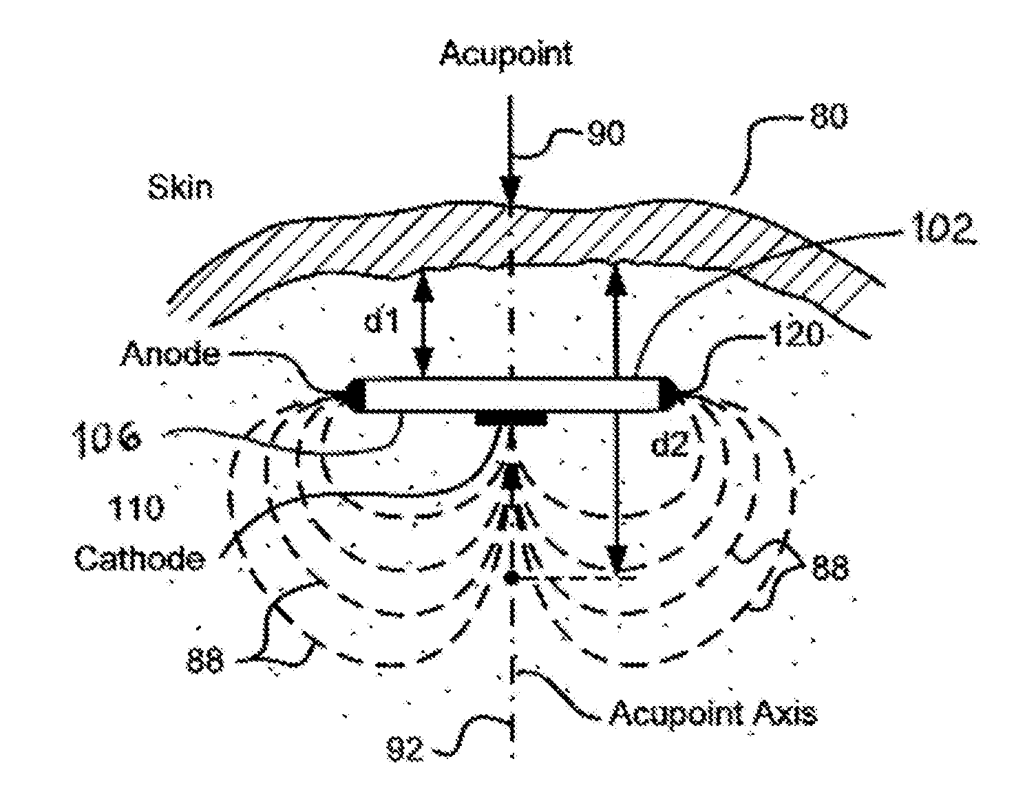 Implantable Electroacupuncture Device and Method