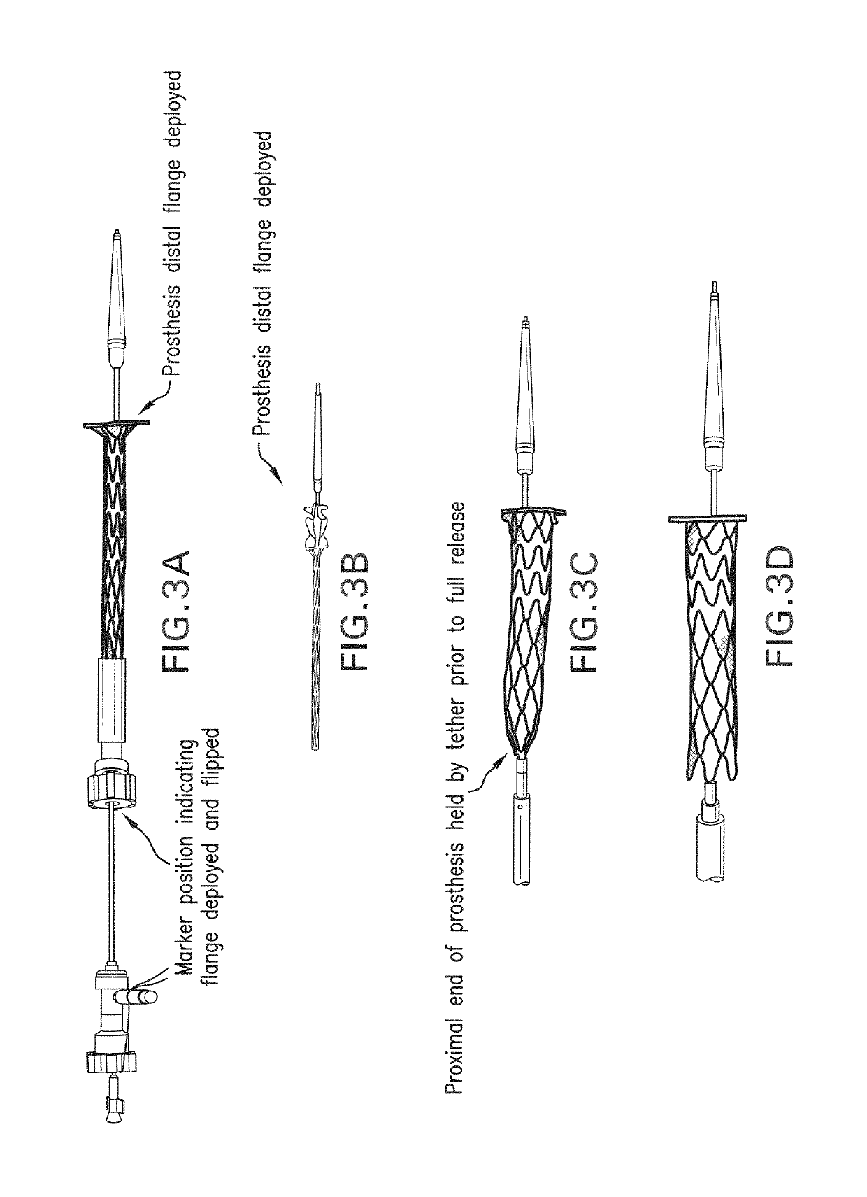 Devices and methods for effectuating percutaneous Glenn and Fontan procedures