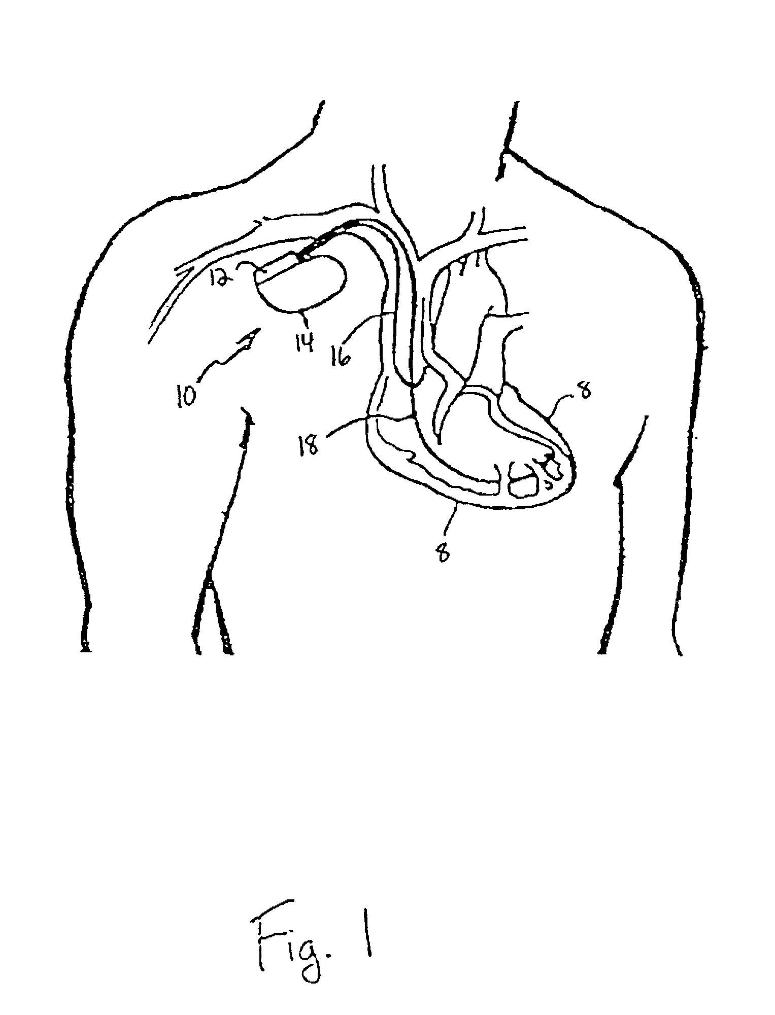 Capture management in multi-site pacing