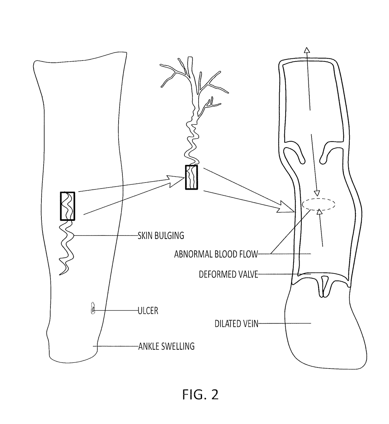 Adaptive compression therapy systems and methods