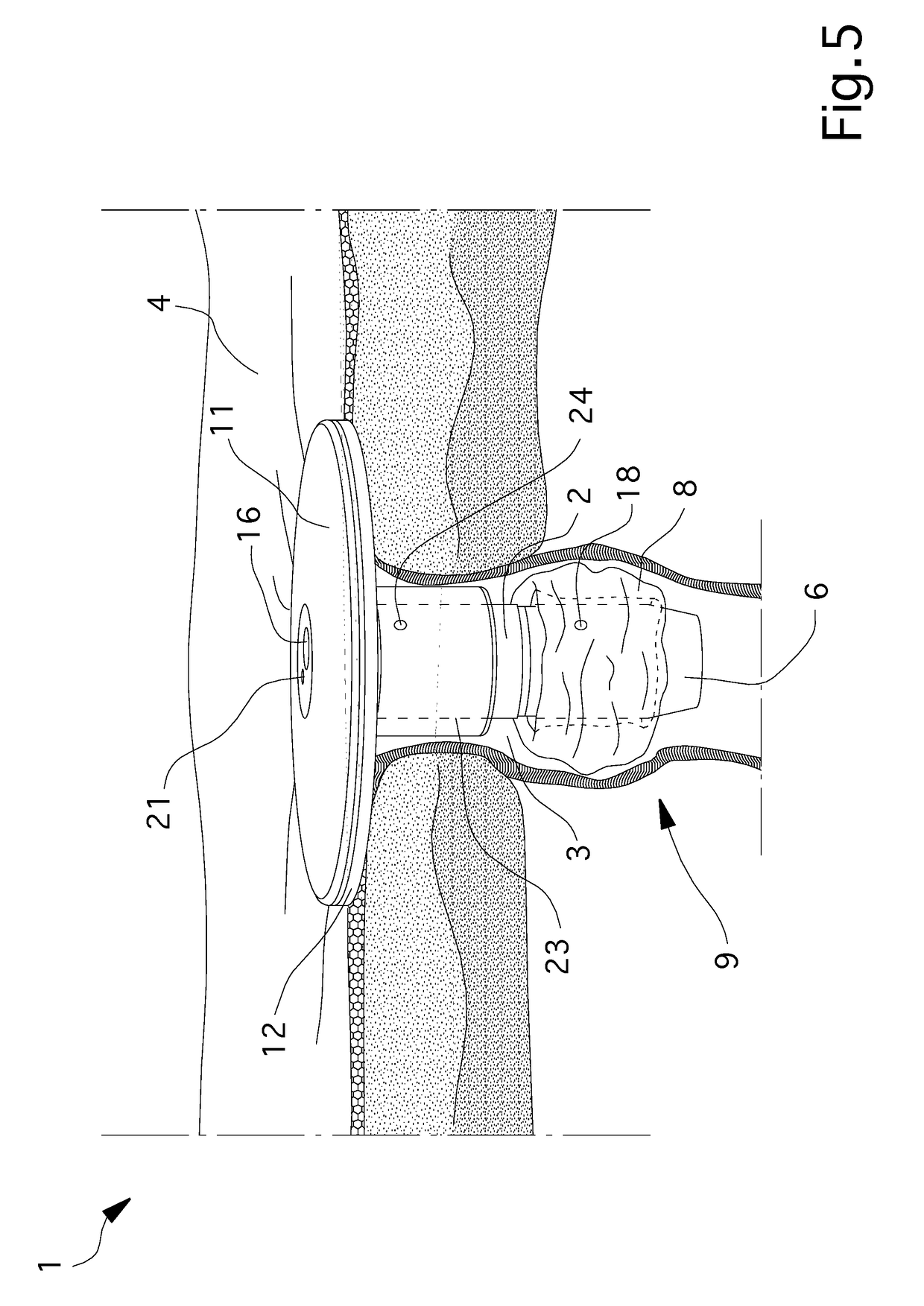 Prosthesis For Enterostomy Patients