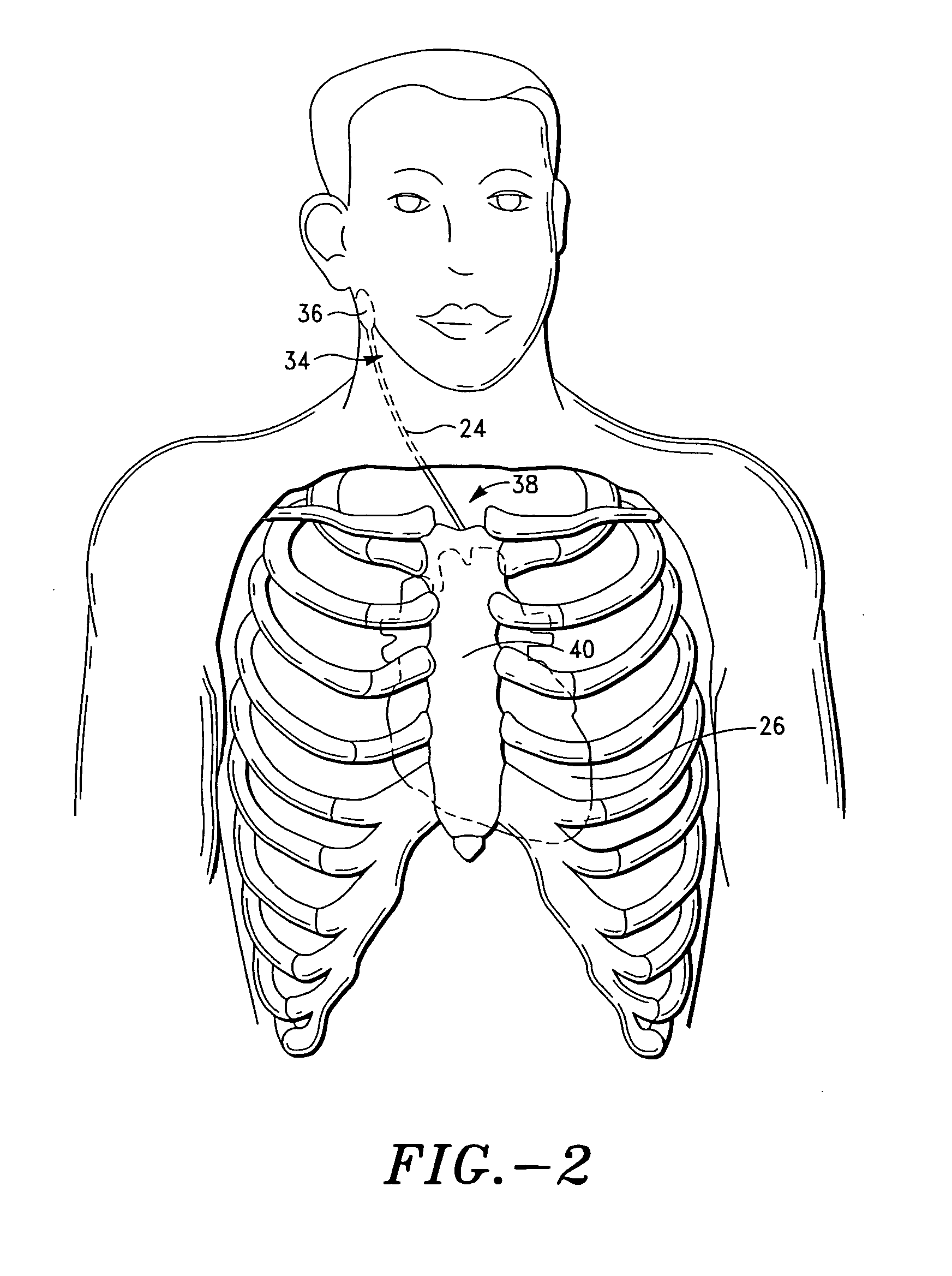 Device and procedure to treat cardiac atrial arrhythmias