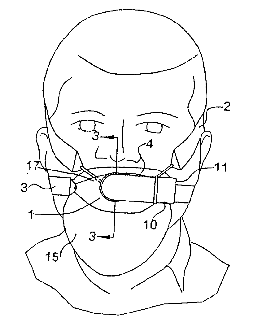 Mouthpiece, nasal seal, head appliance, apparatus, and methods of treating sleep apnea