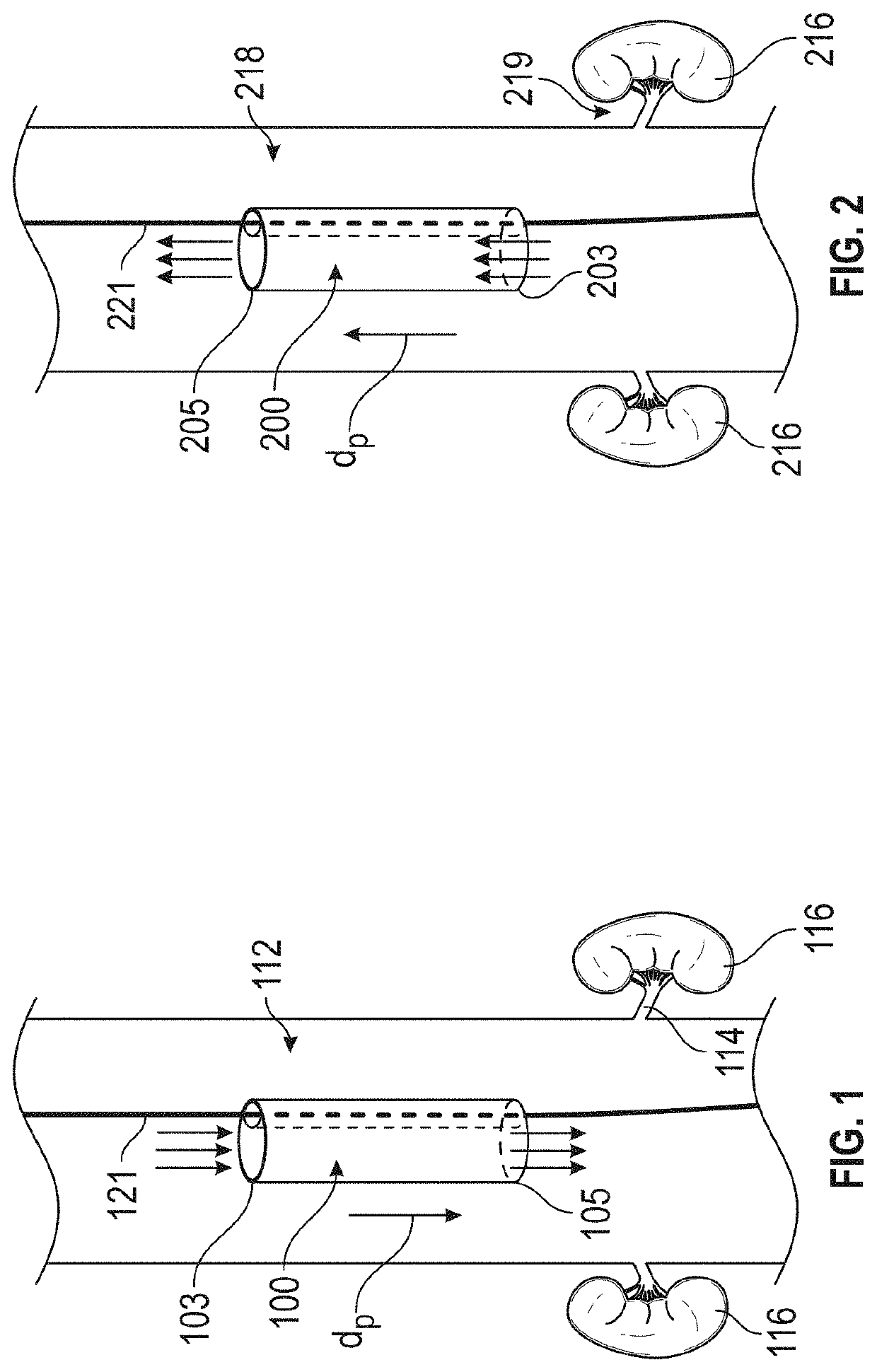 Device for renal decongestion