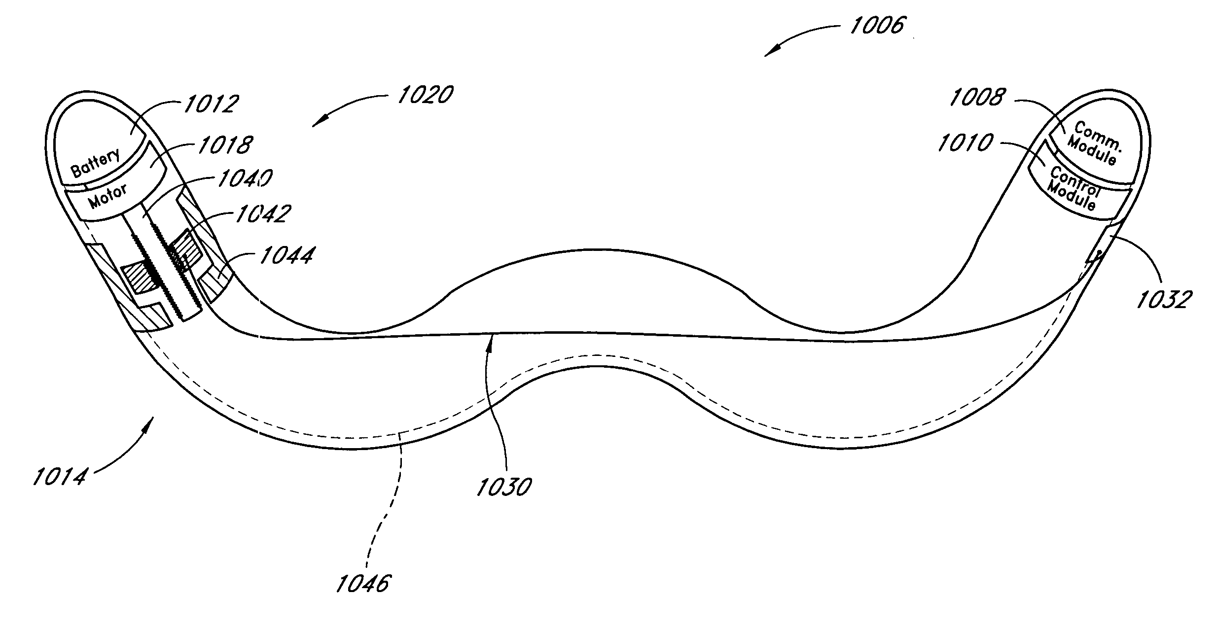 Remotely activated mitral annuloplasty system and methods