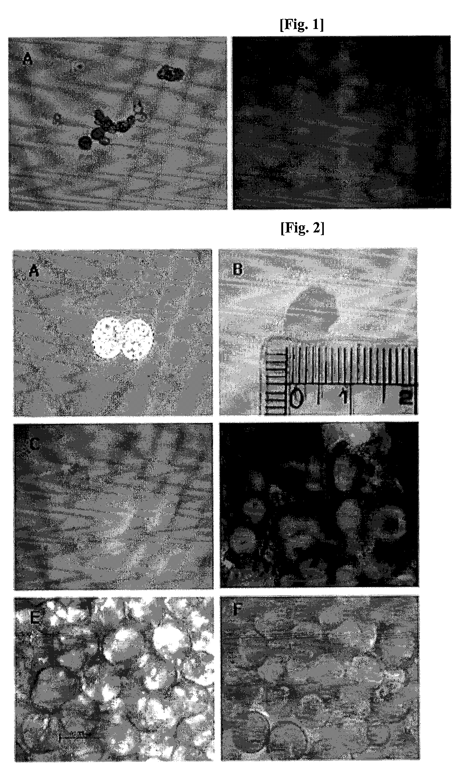 Transplantation of Differentiated Immature Adipocytes and Biodegradable Scaffold for Tissue Augmentation