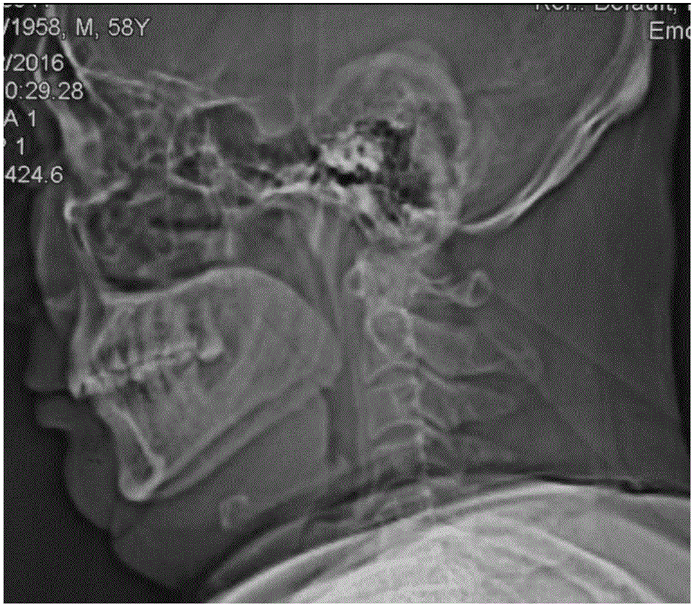 Titanium-alloy cervical anterior elastic underjaw-supporting snore-ceasing device