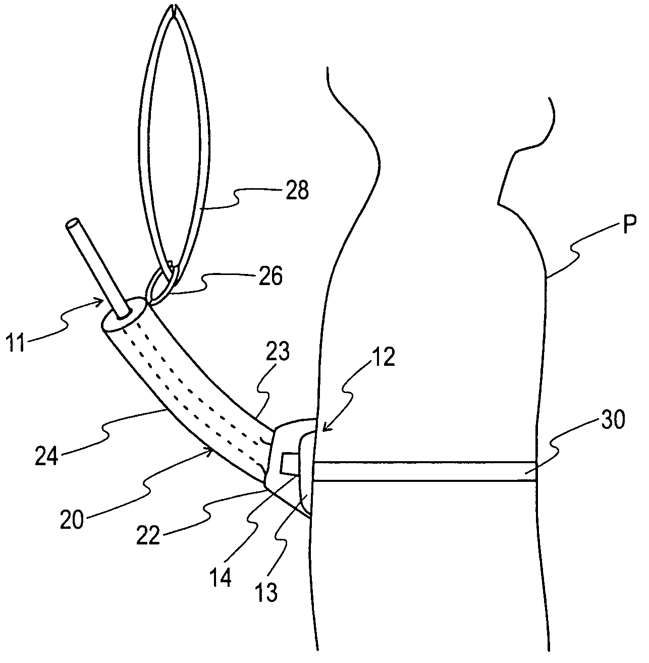 G-tube retainer