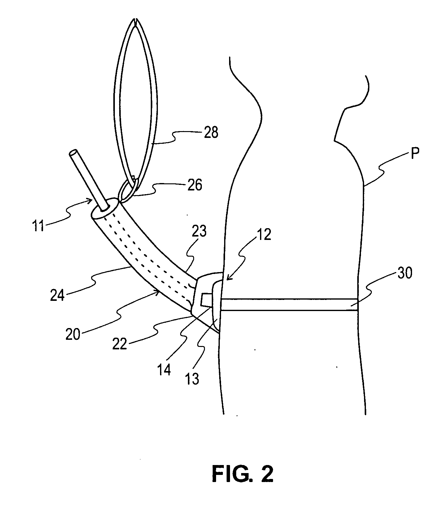 G-tube retainer