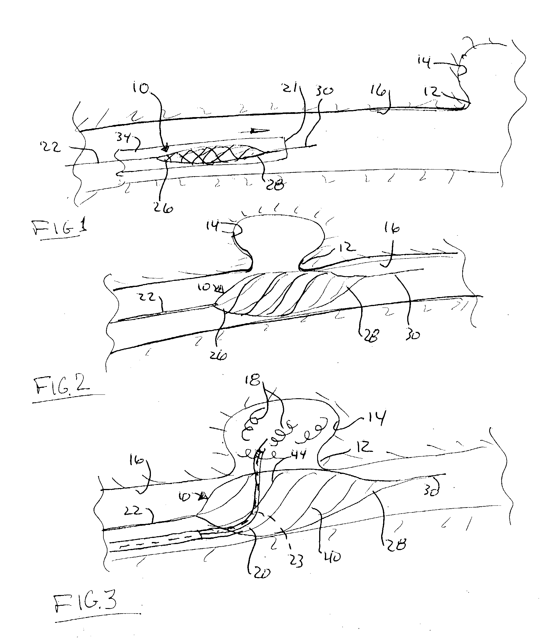 Aneurysm buttress arrangement