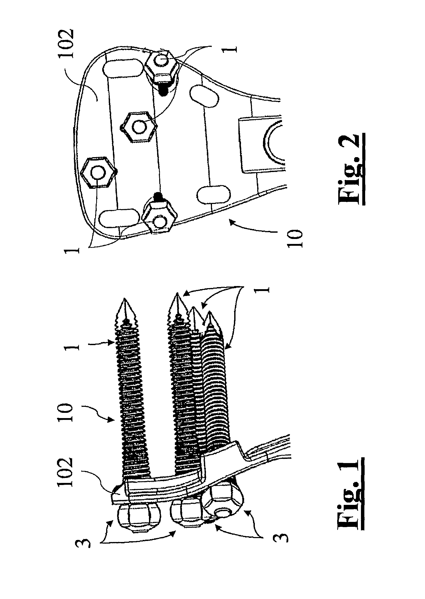 Endosseous screws and orthopaedic device to assist the rigid osteosynthesis of fractures