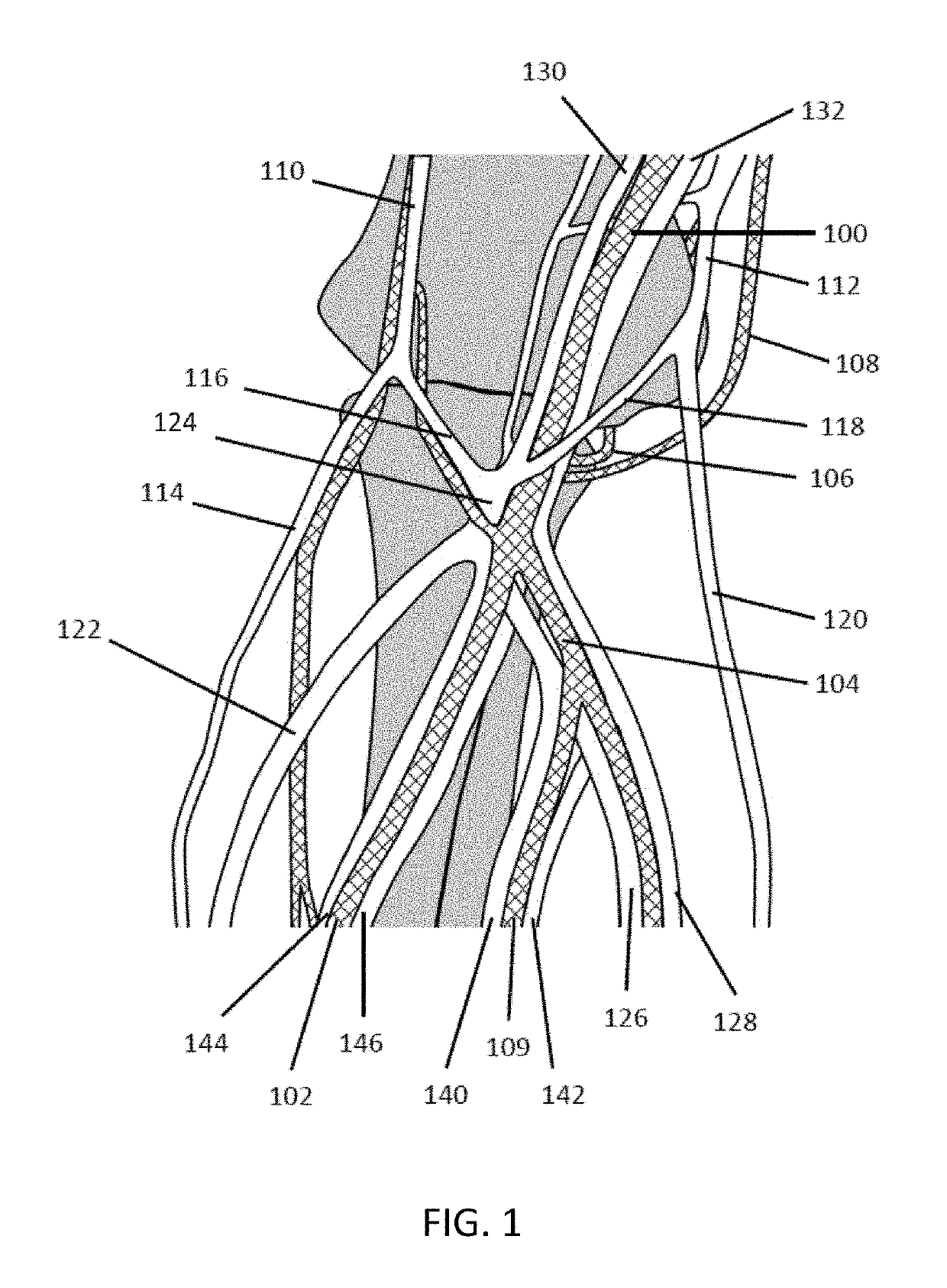 Methods for treating hypertension and reducing blood pressure with formation of fistula