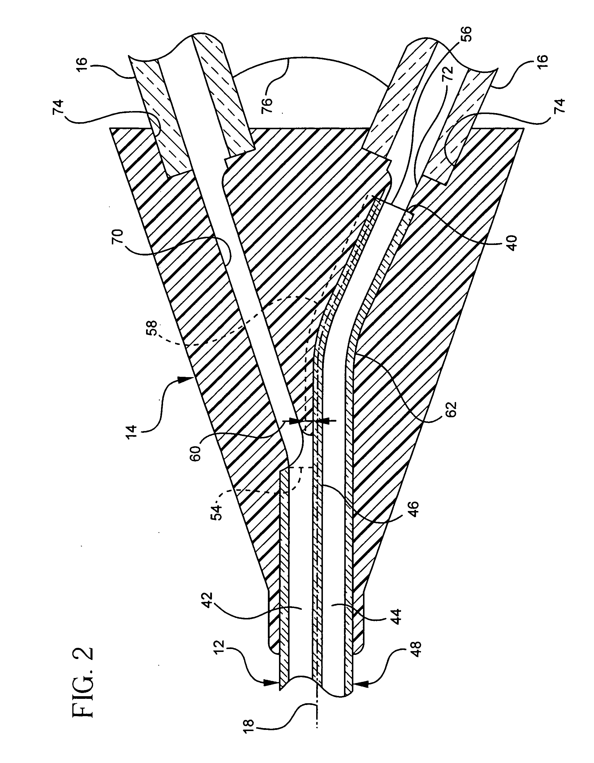 Catheter having staggered lumens and method