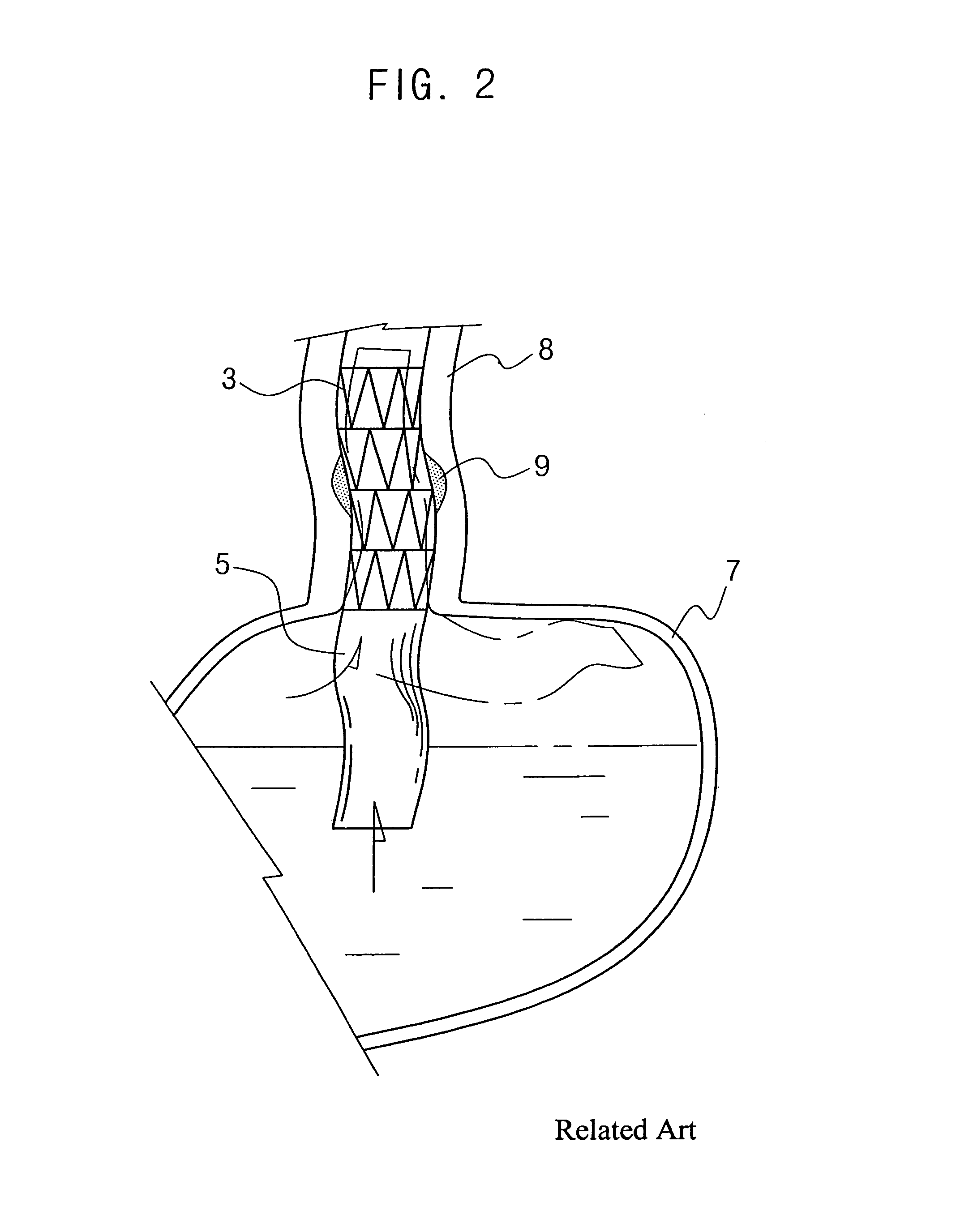 Esophageal stent