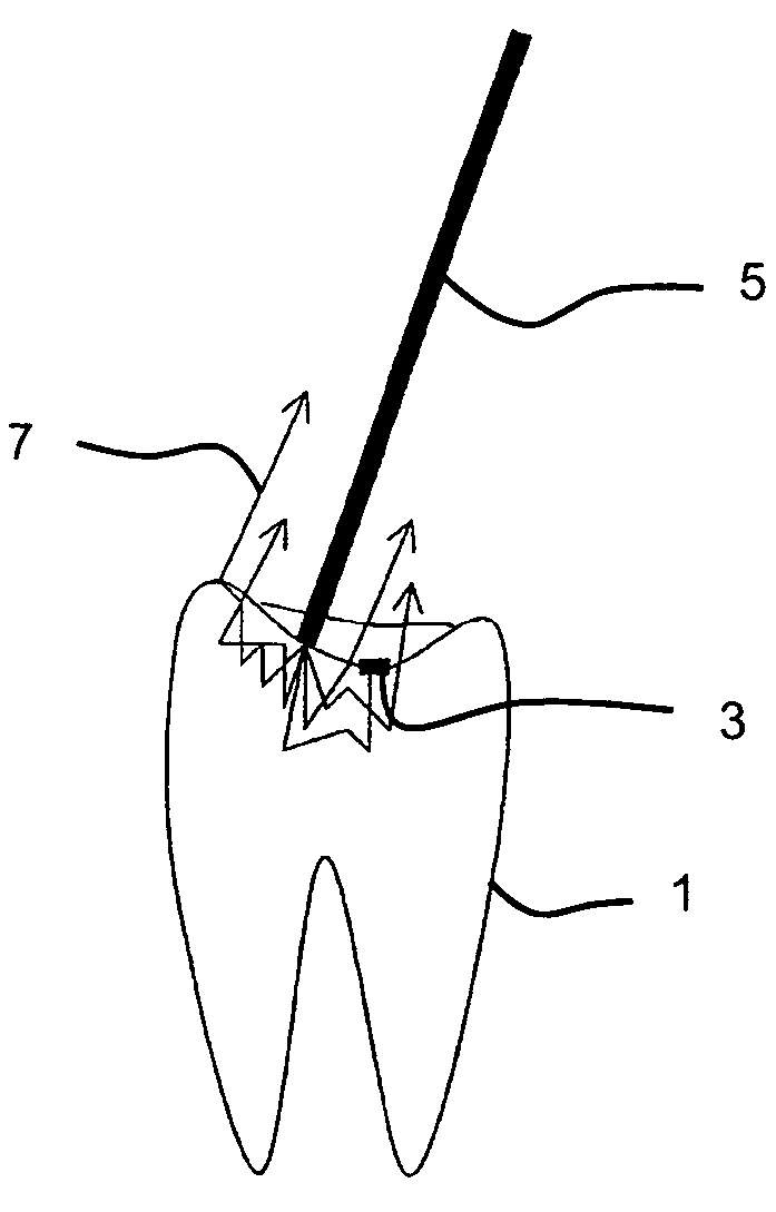 Method for identifying tooth-colored tooth filling residues