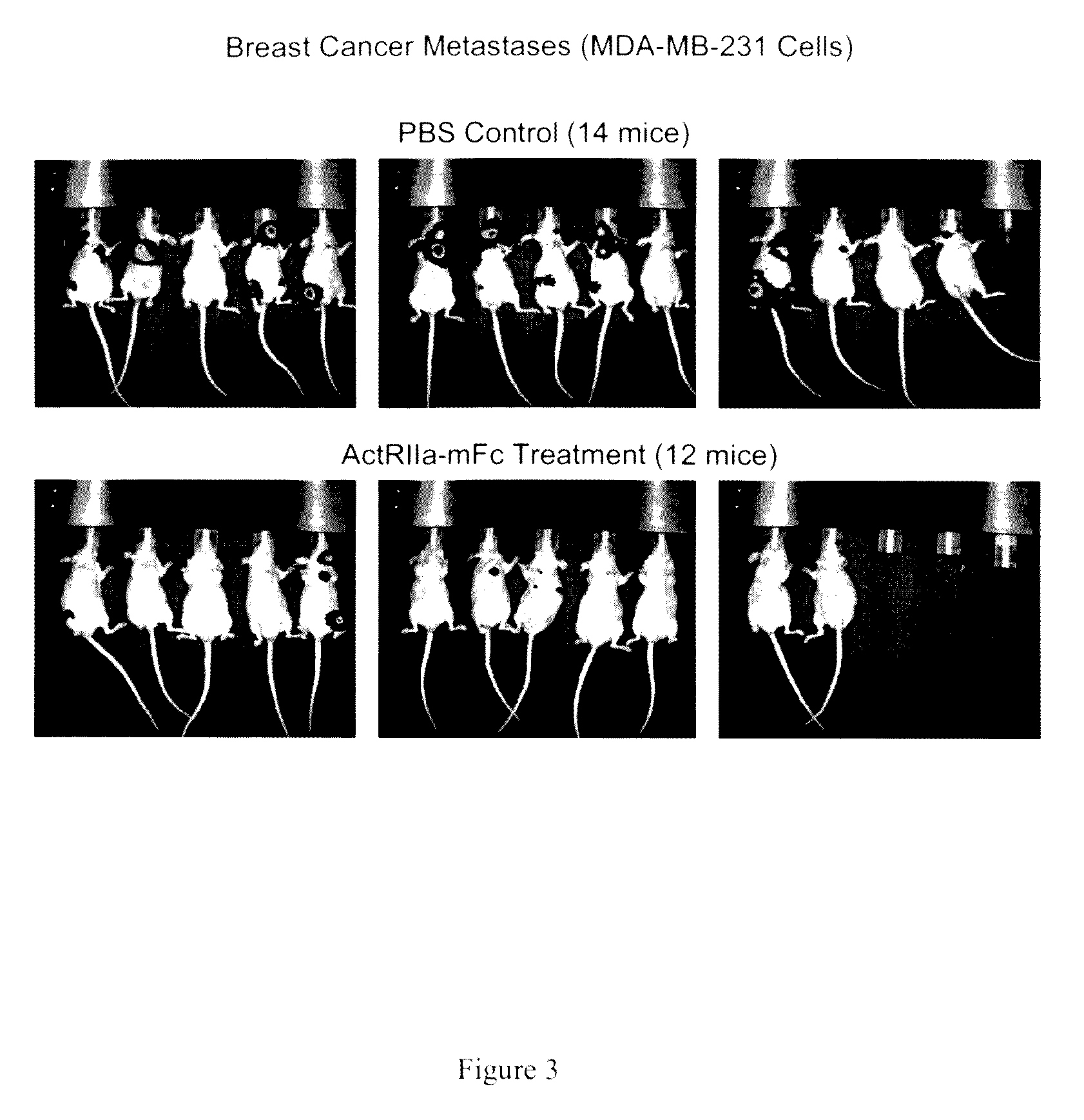 Activin-actriia antagonists and uses for treating or preventing breast cancer