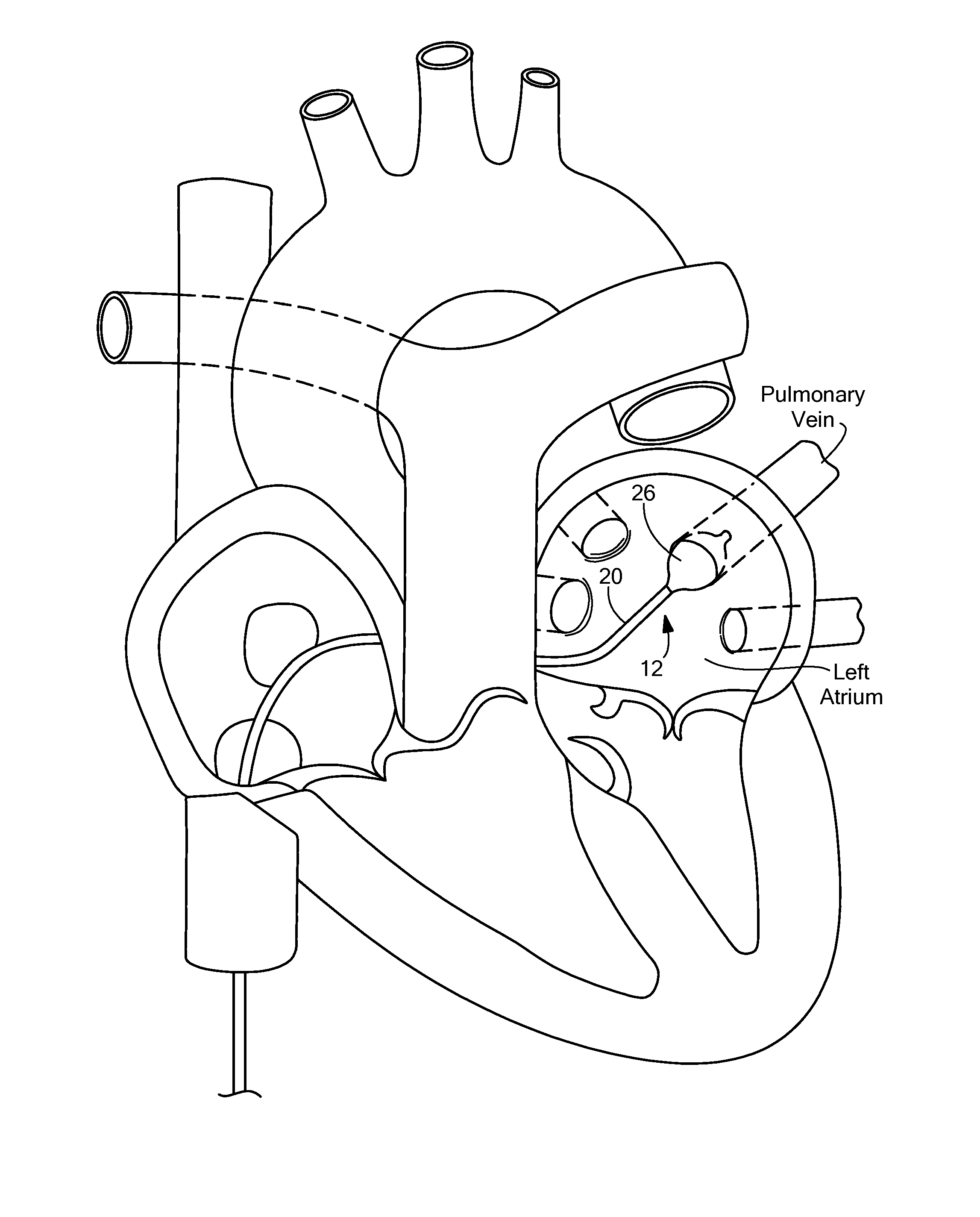 Compliant balloon with liquid injection