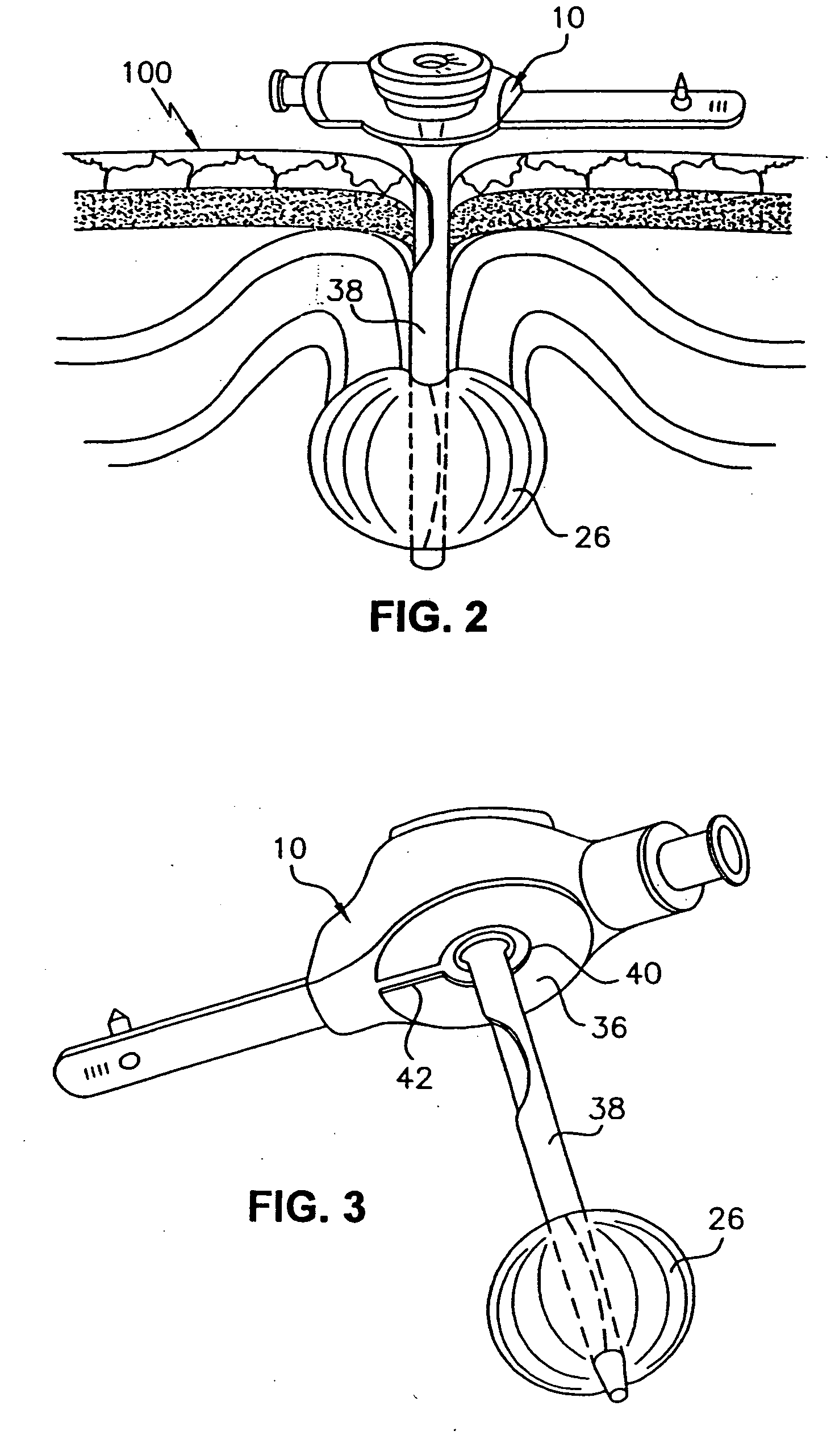 Low profile combination device for gastrostomy or jejunostomy applications having anti-granuloma formation characteristics