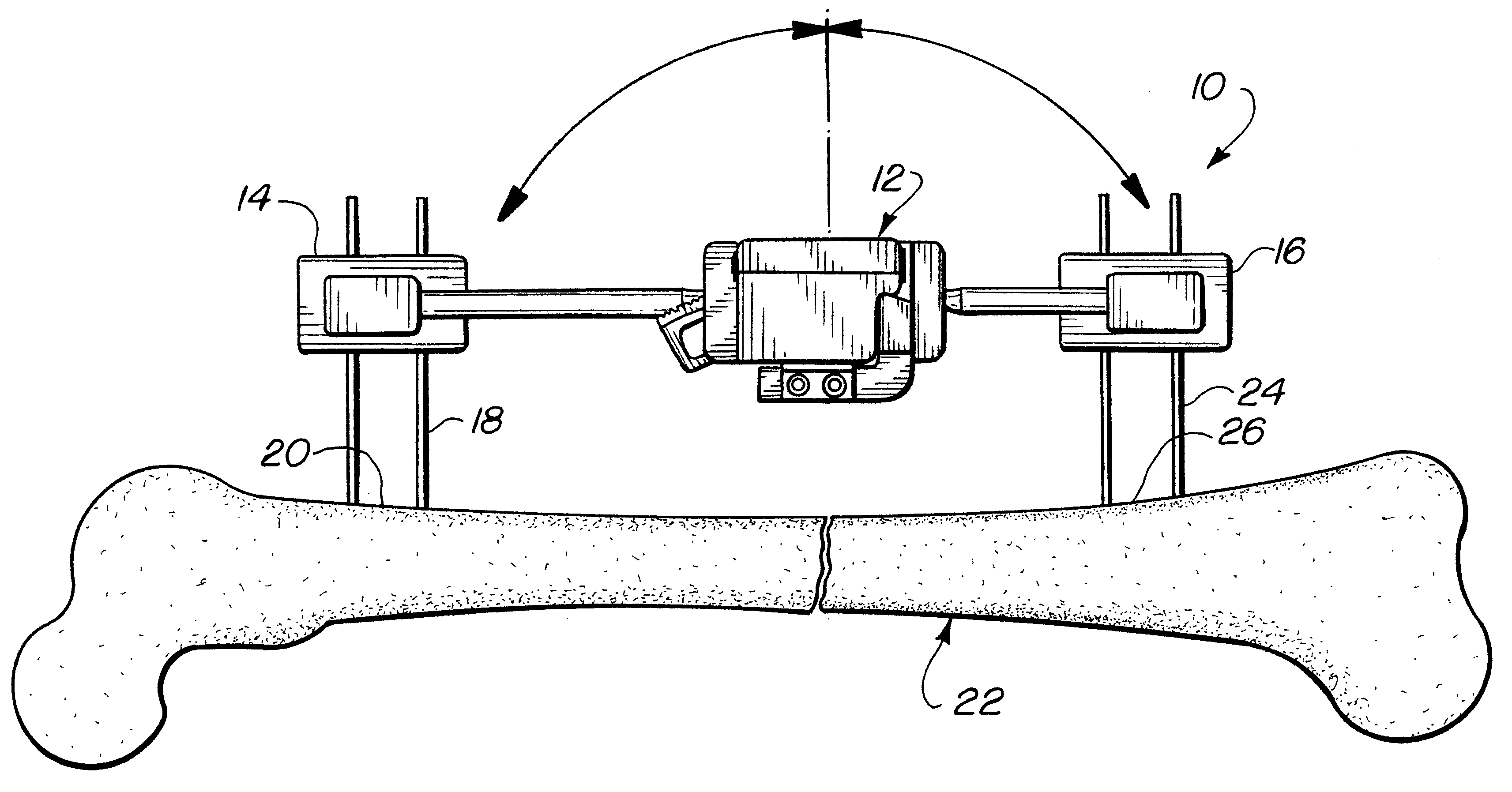 External fixator including an angular correction module and related method