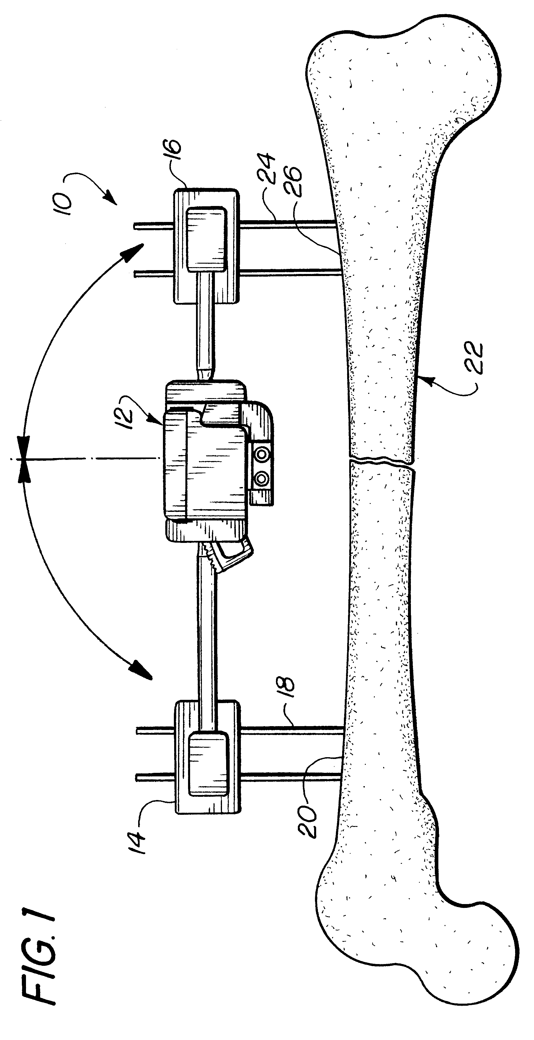 External fixator including an angular correction module and related method