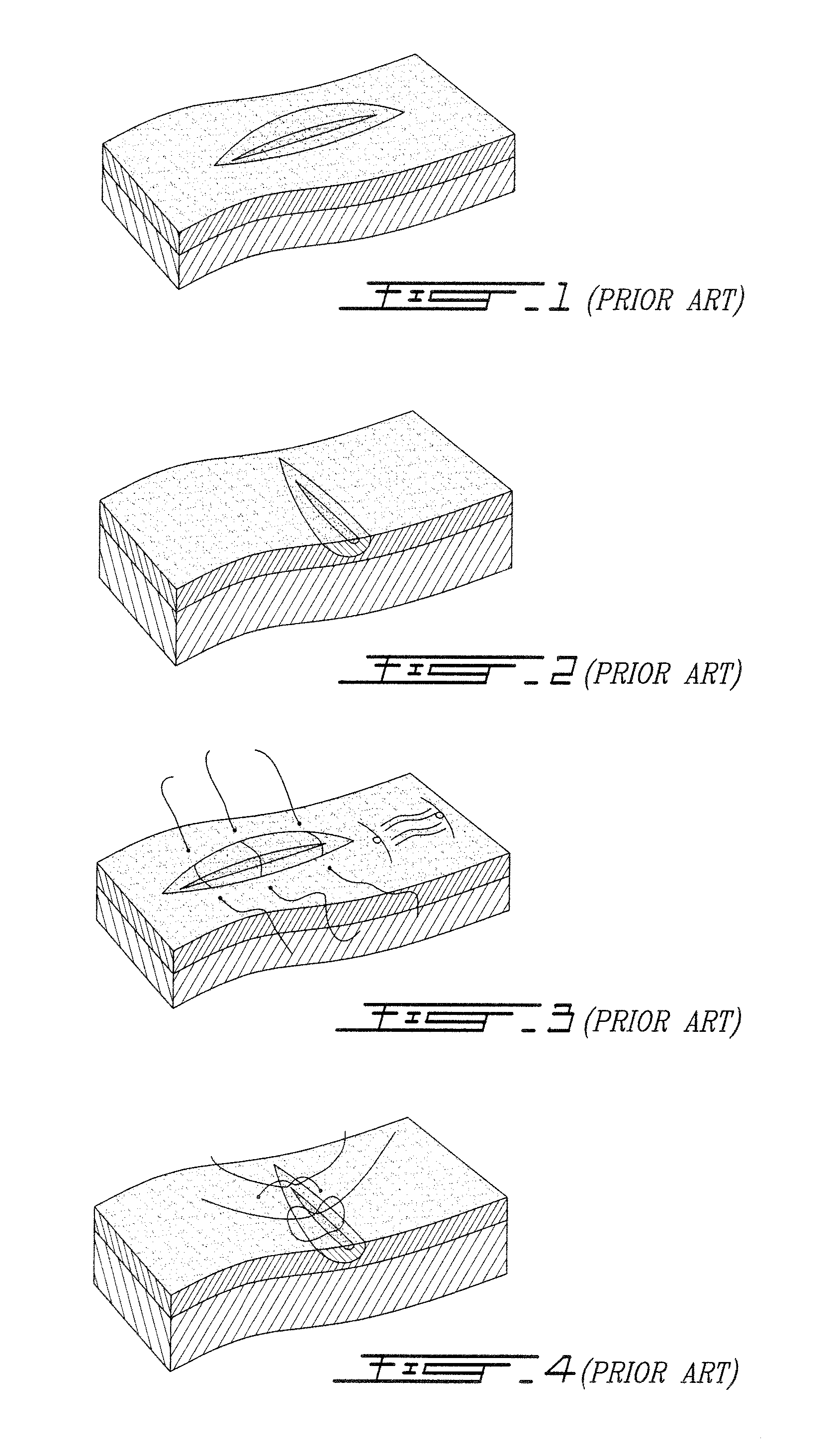 Auto-graft bio-synthetic mesh for ventral and parastomal hernia repair and method of attachment