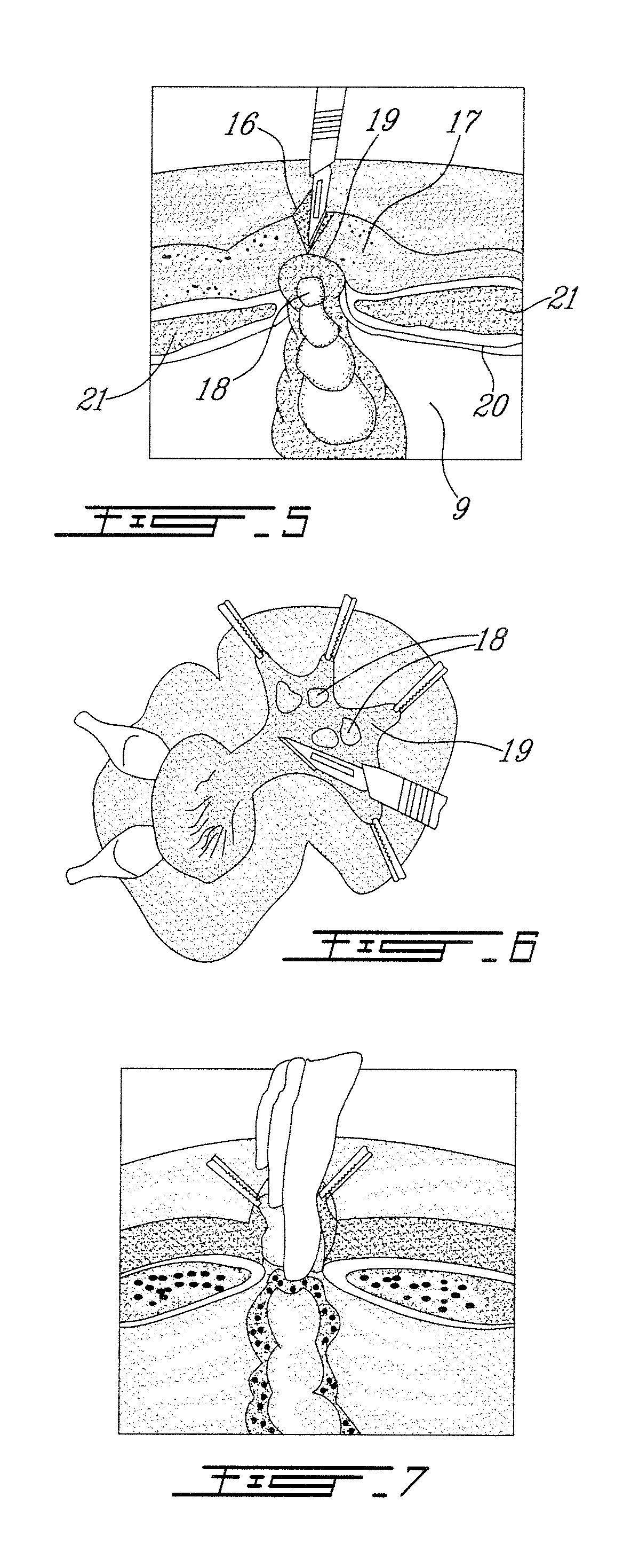 Auto-graft bio-synthetic mesh for ventral and parastomal hernia repair and method of attachment