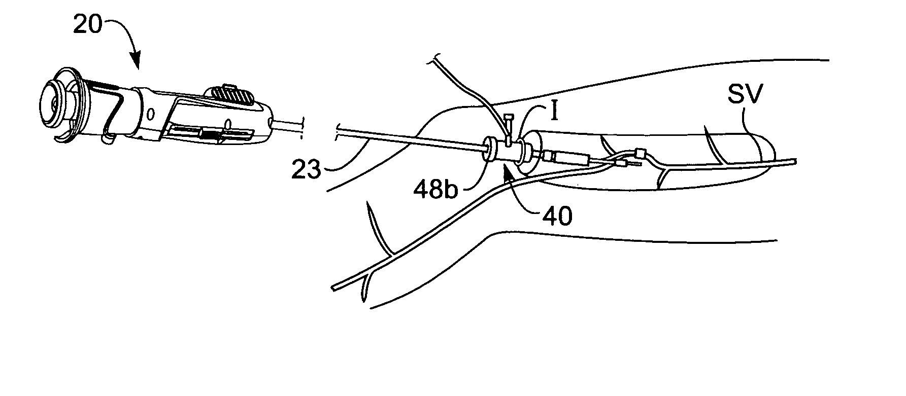 Modular vessel harvesting system and method