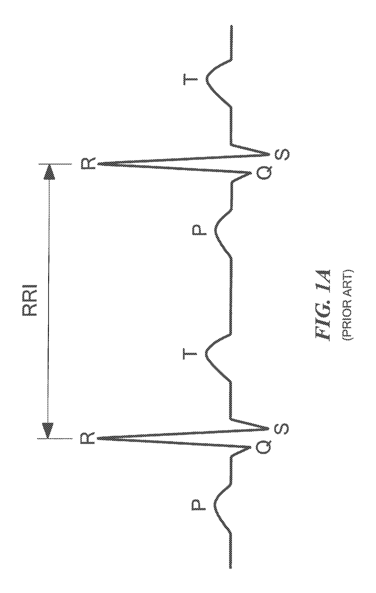 Systems and methods for detecting a physiological abnormality in a patient by using cardiac or other chaos in combination with non-increasing parasympathetic modulation