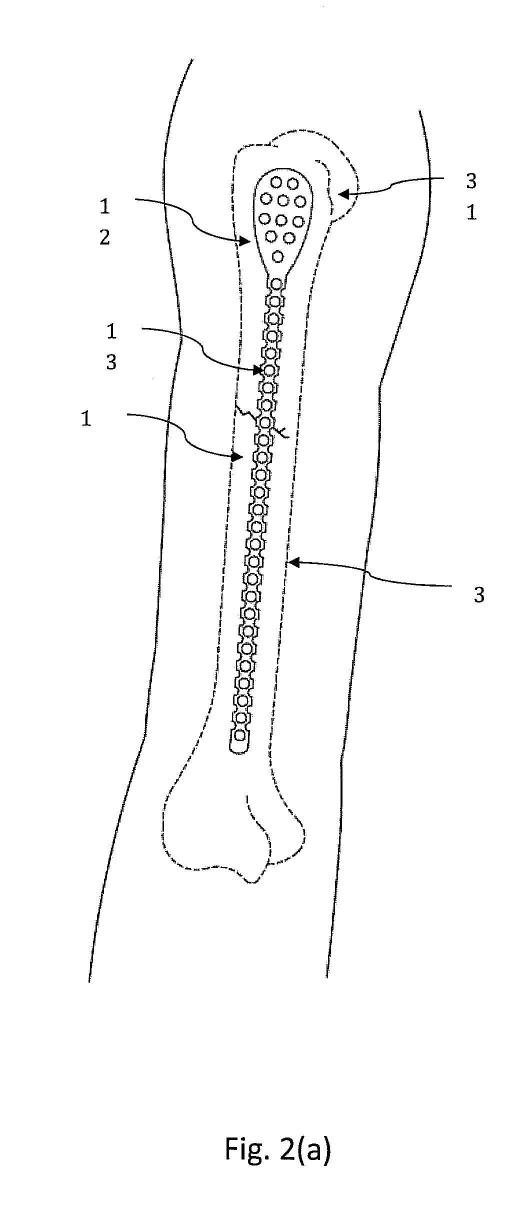 Bendable bone plate for external fixation