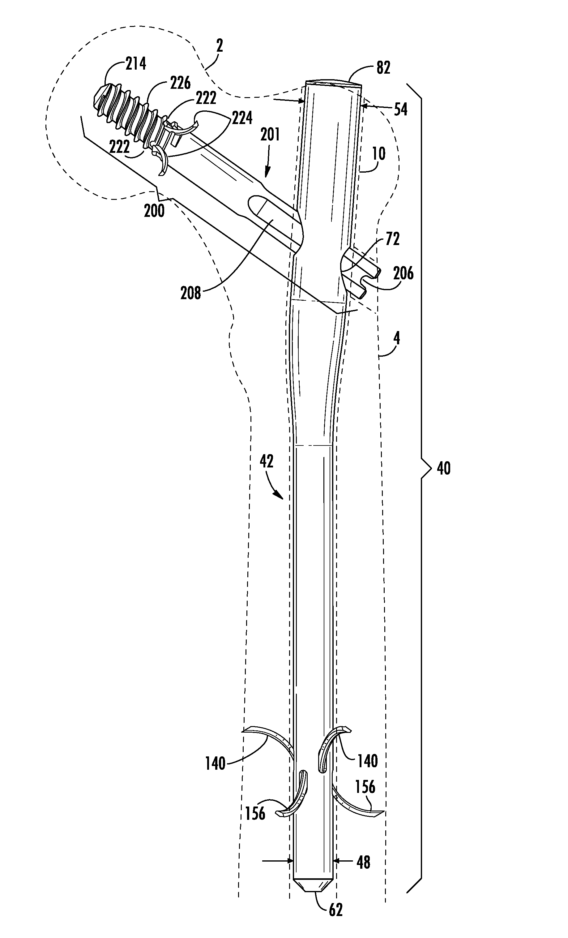 Intramedullary nail system with tang fixation