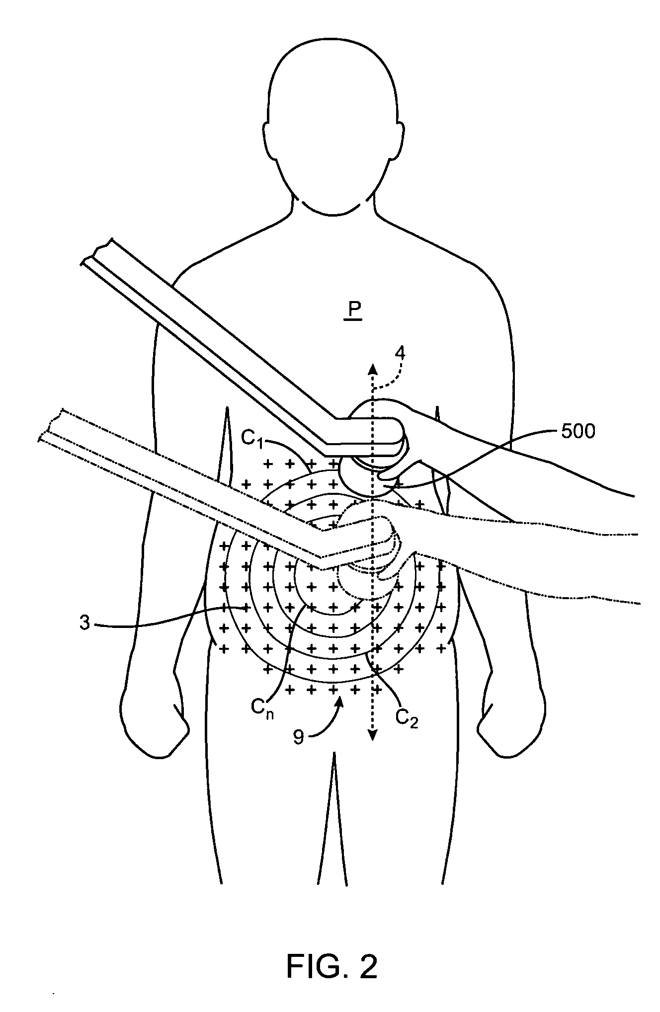 Apparatus and methods for the destruction of adipose tissue