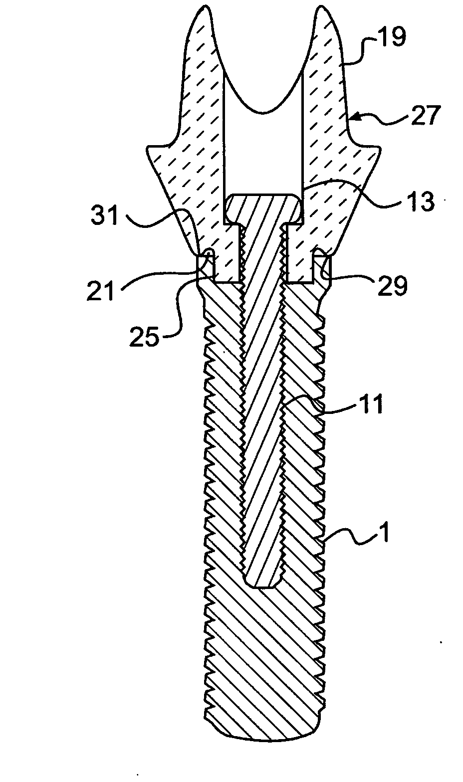 Dental abutment including fillet