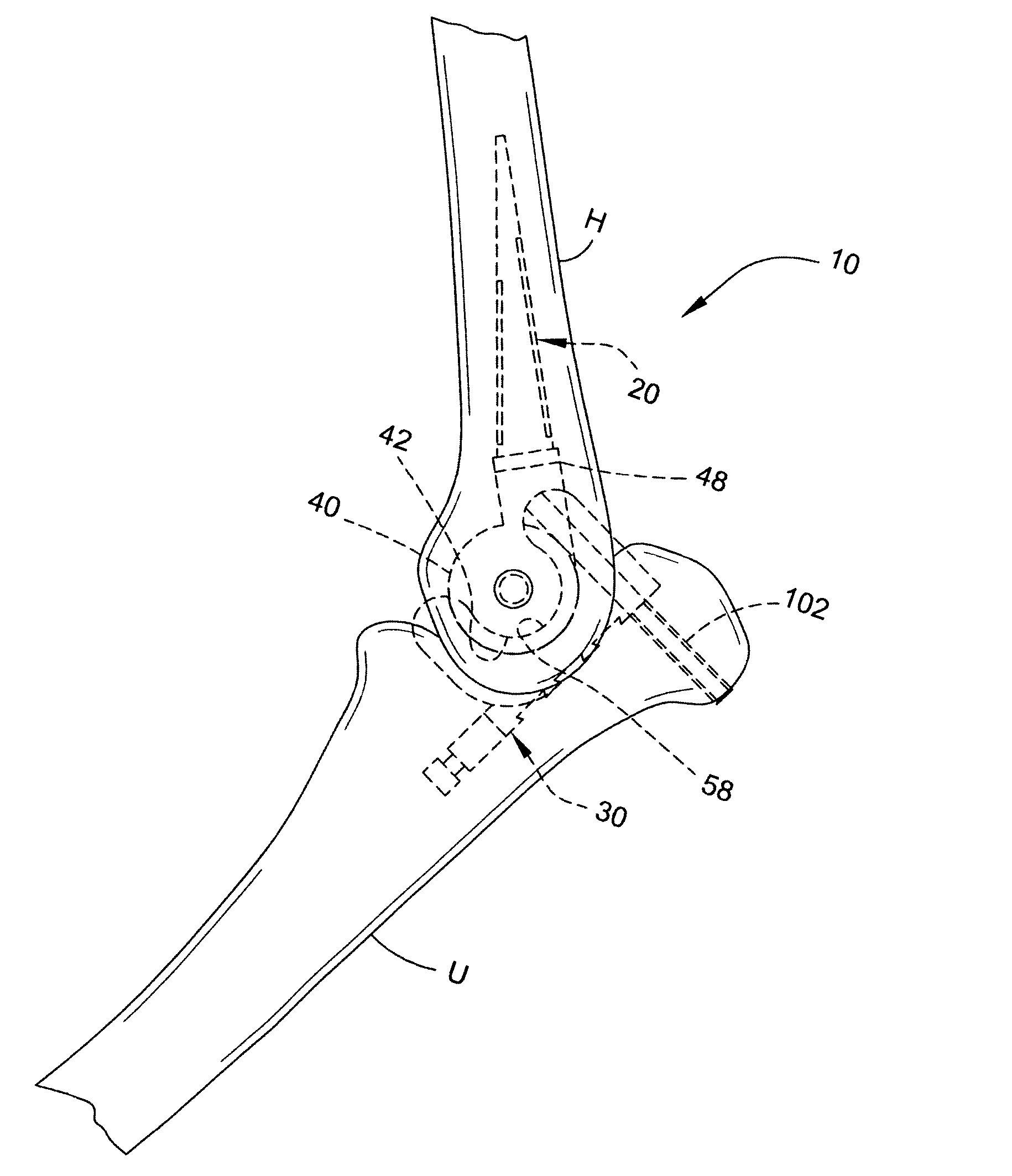 Elbow arthroplasty system