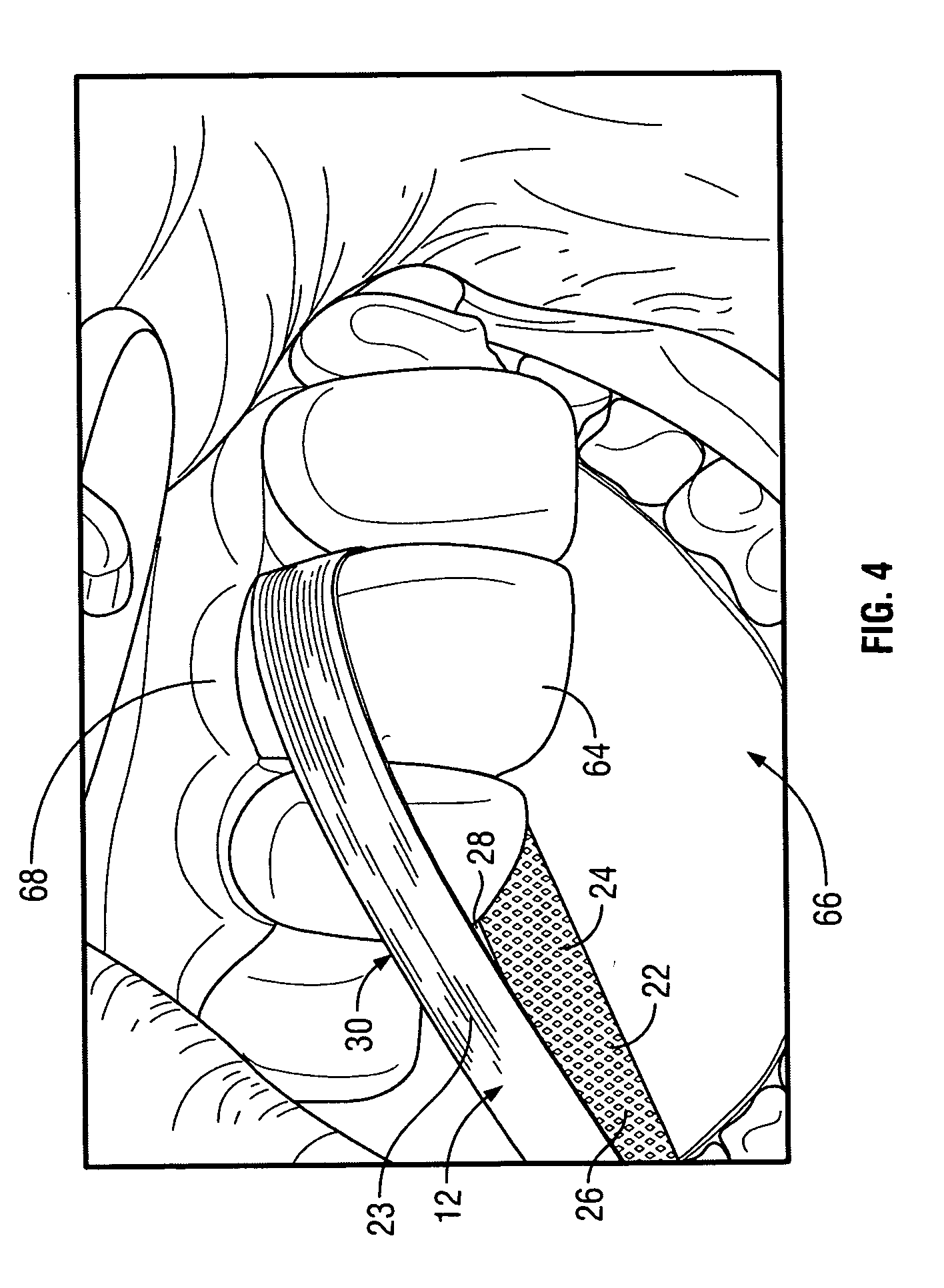 Dental finishing device