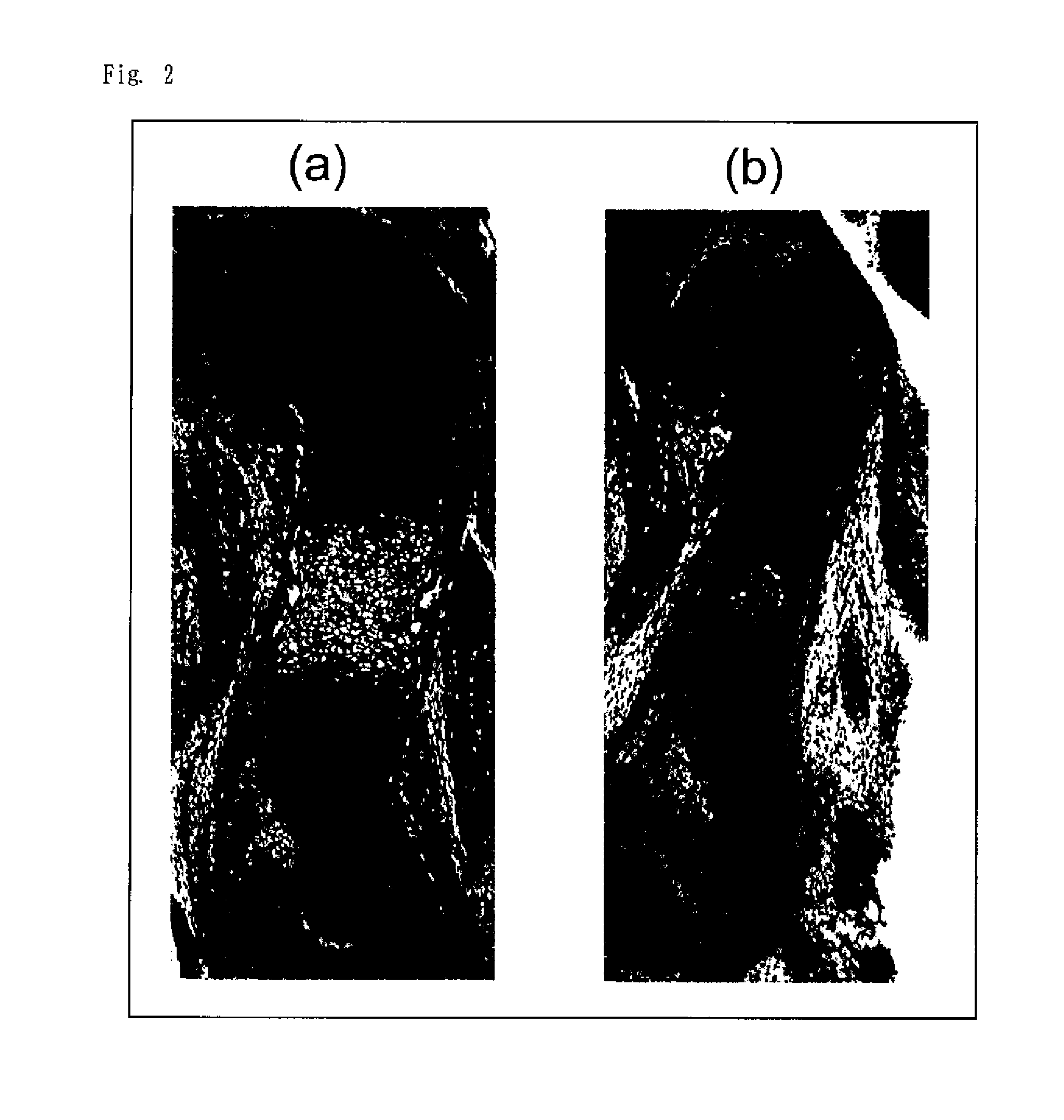 Screening method for therapeutic agent for chondropathy and modified chondrocyte for treatment of chondropathy