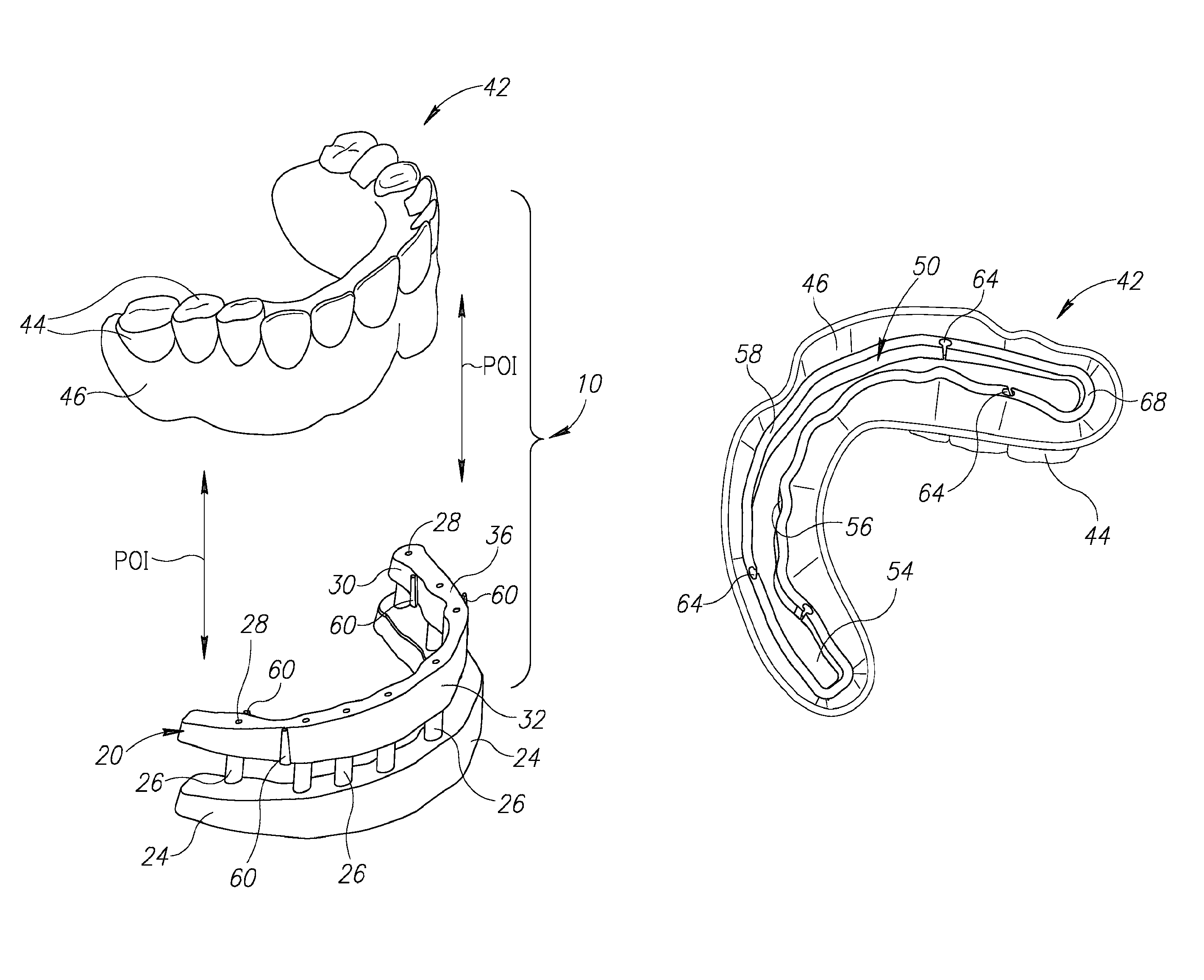 Denture stabilization system and method