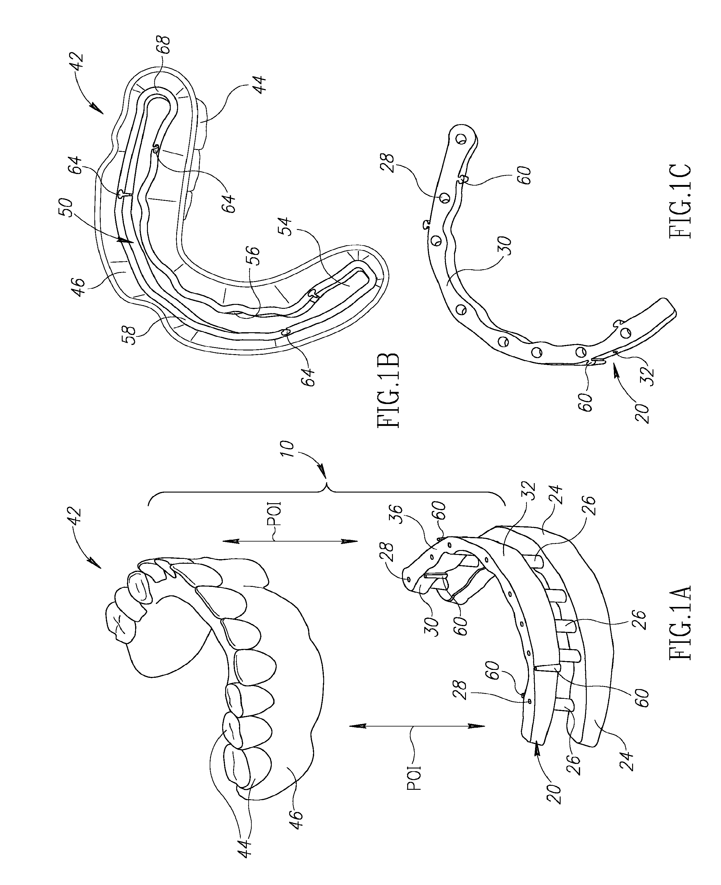 Denture stabilization system and method