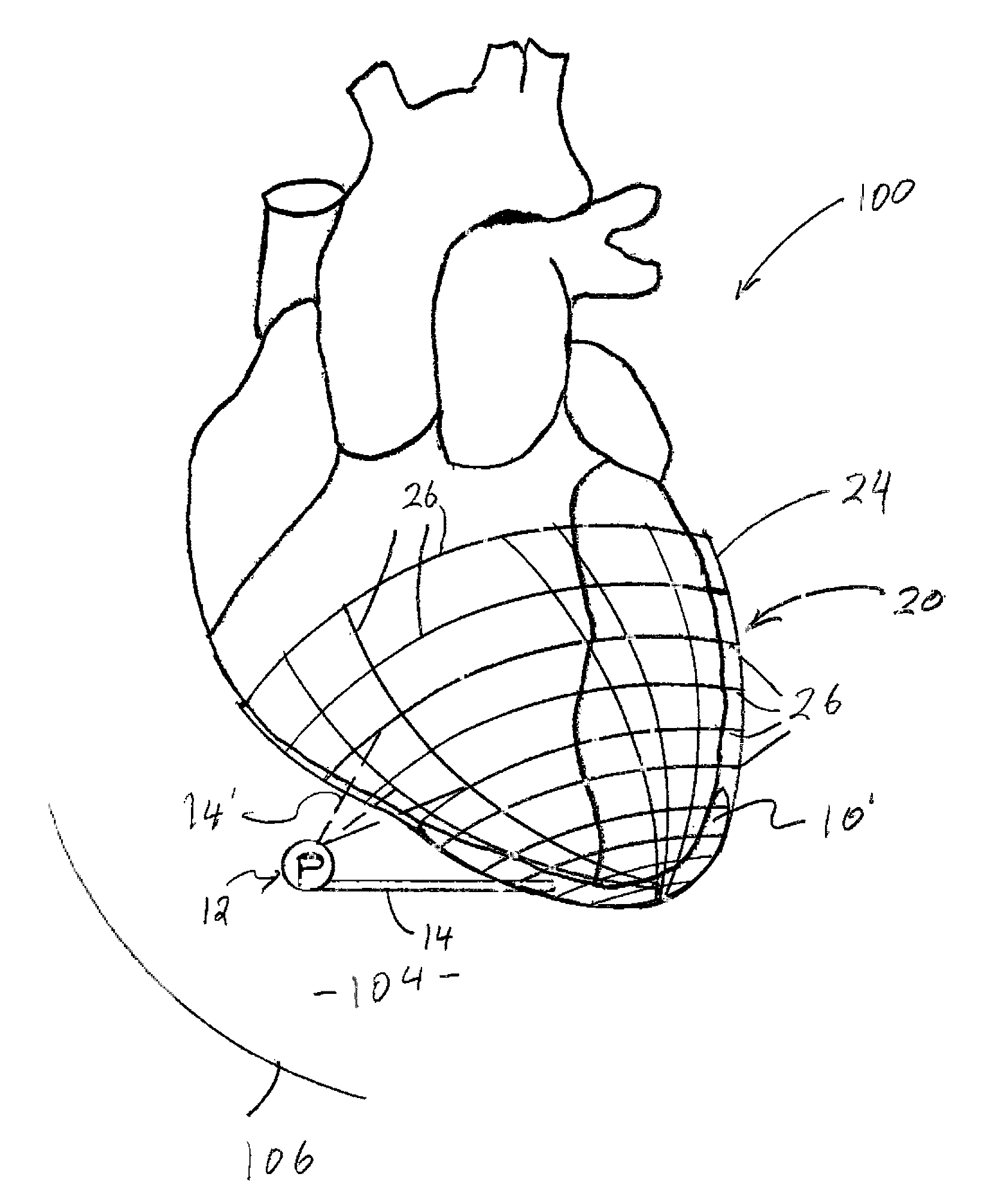 System for treating heart valve malfunction including mitral regurgitation