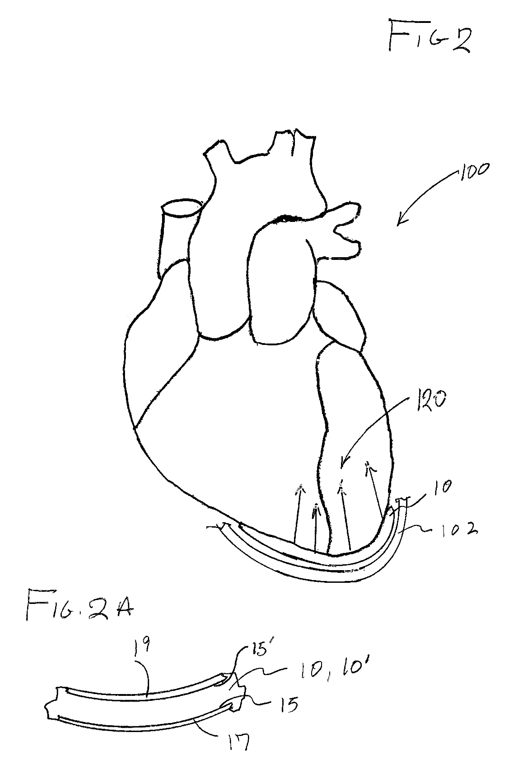 System for treating heart valve malfunction including mitral regurgitation