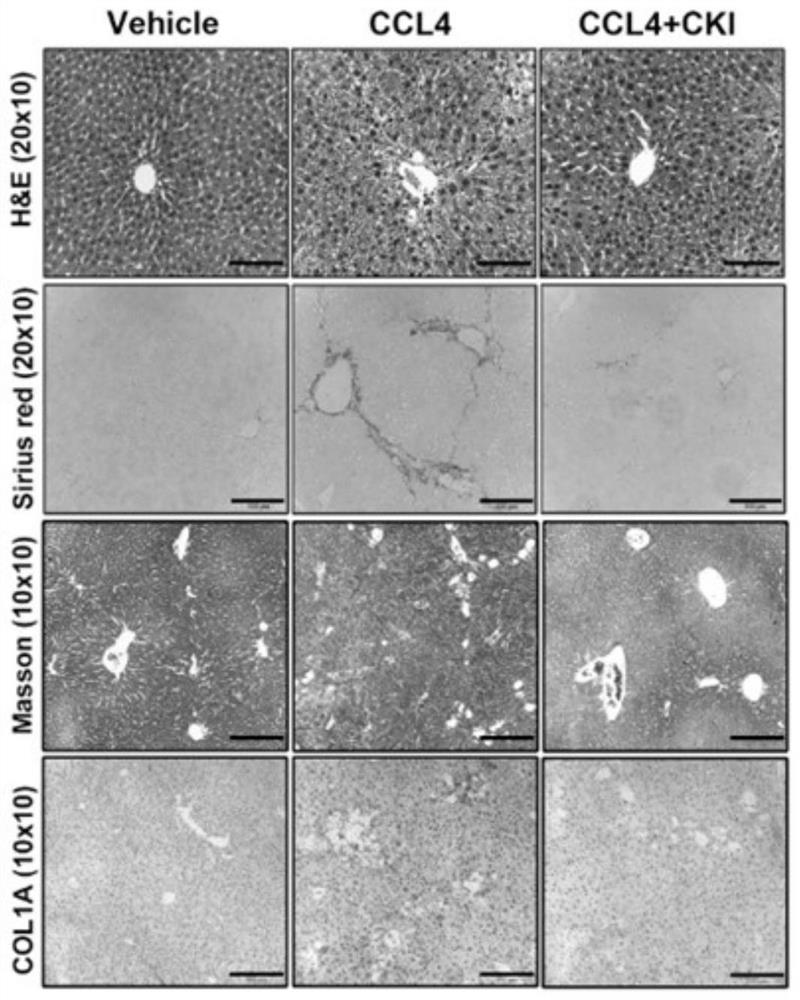 Application of compound kushen injection in preparation of medicine for treating chronic hepatic fibrosis