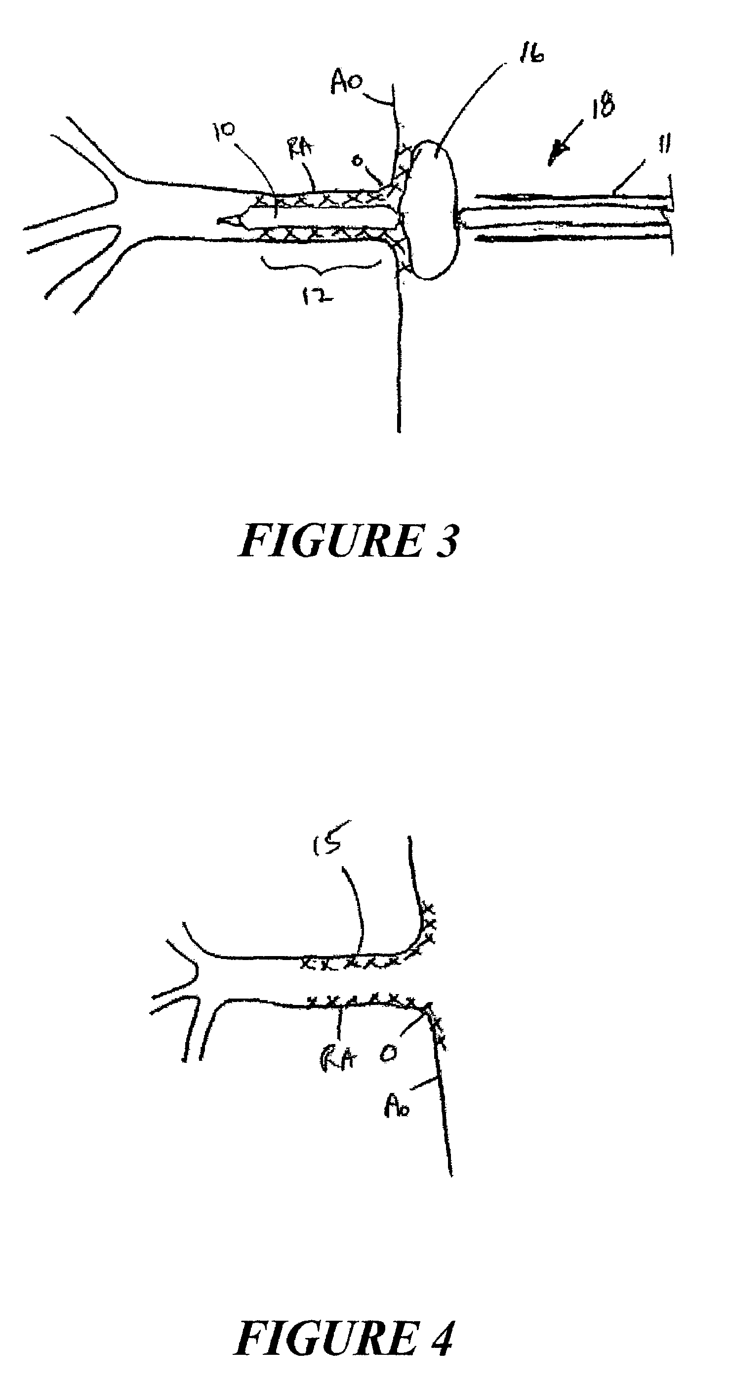 Stent and stent delivery system for ostial locations in a conduit