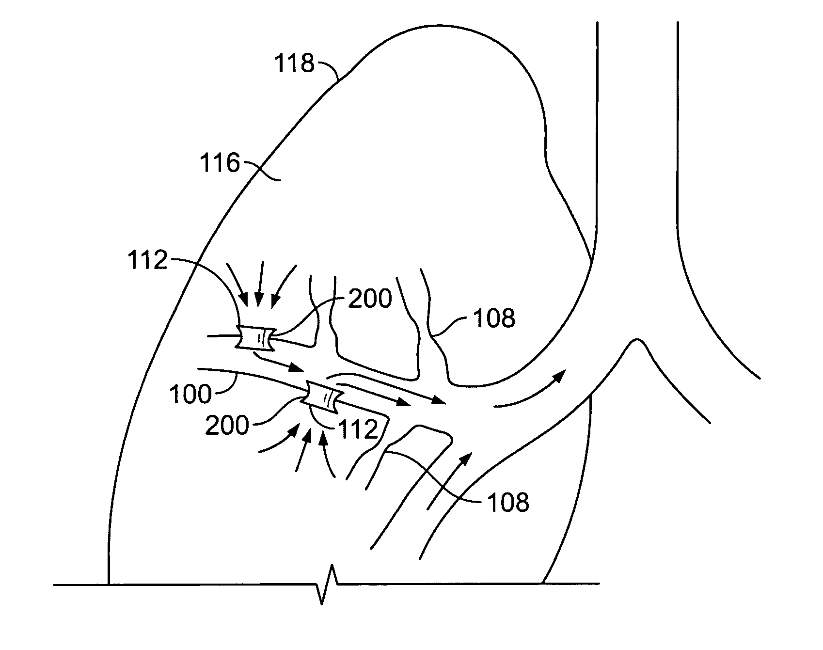 Methods and devices for maintaining patency of surgically created channels in a body organ