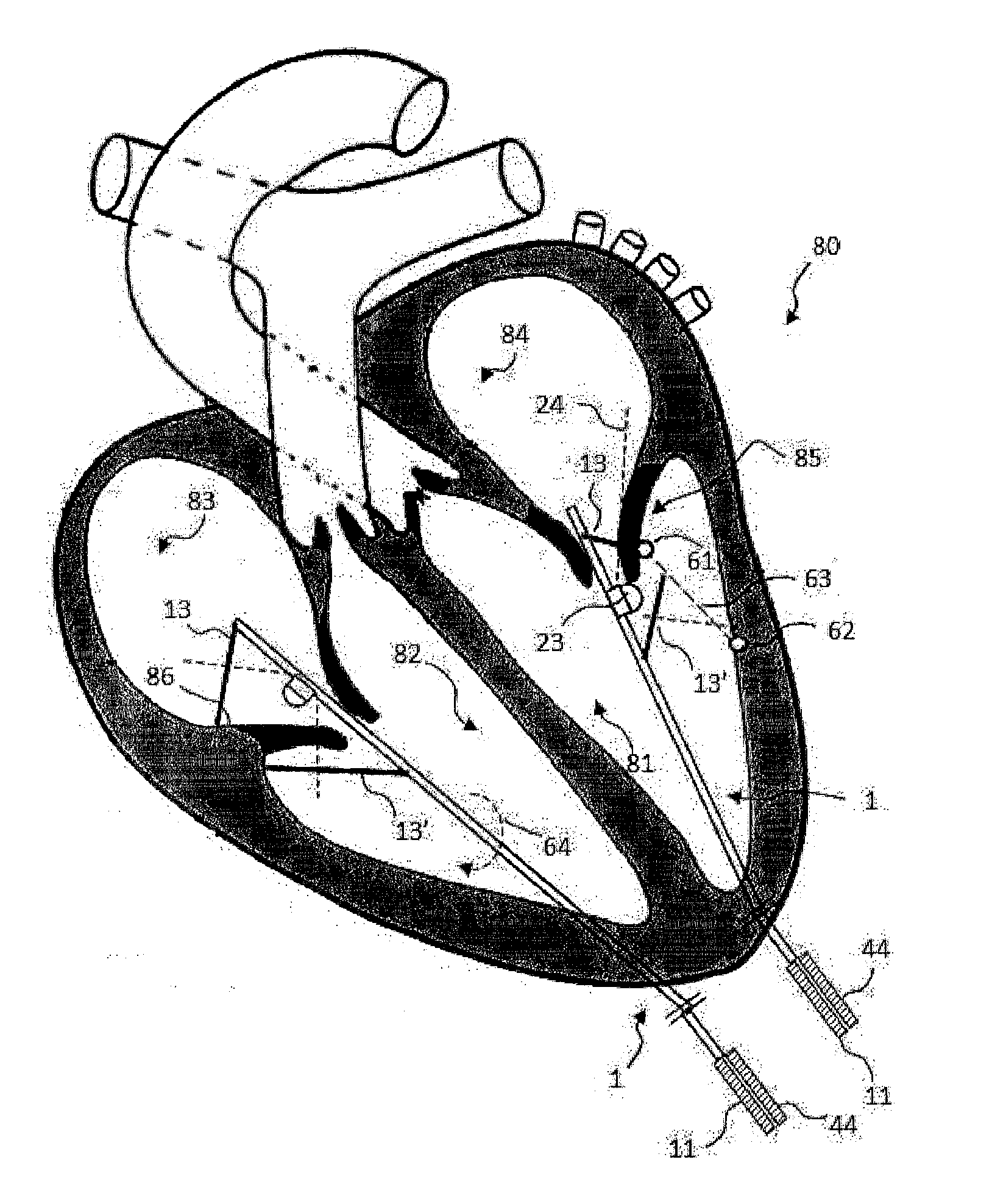 Catheter and associated methods