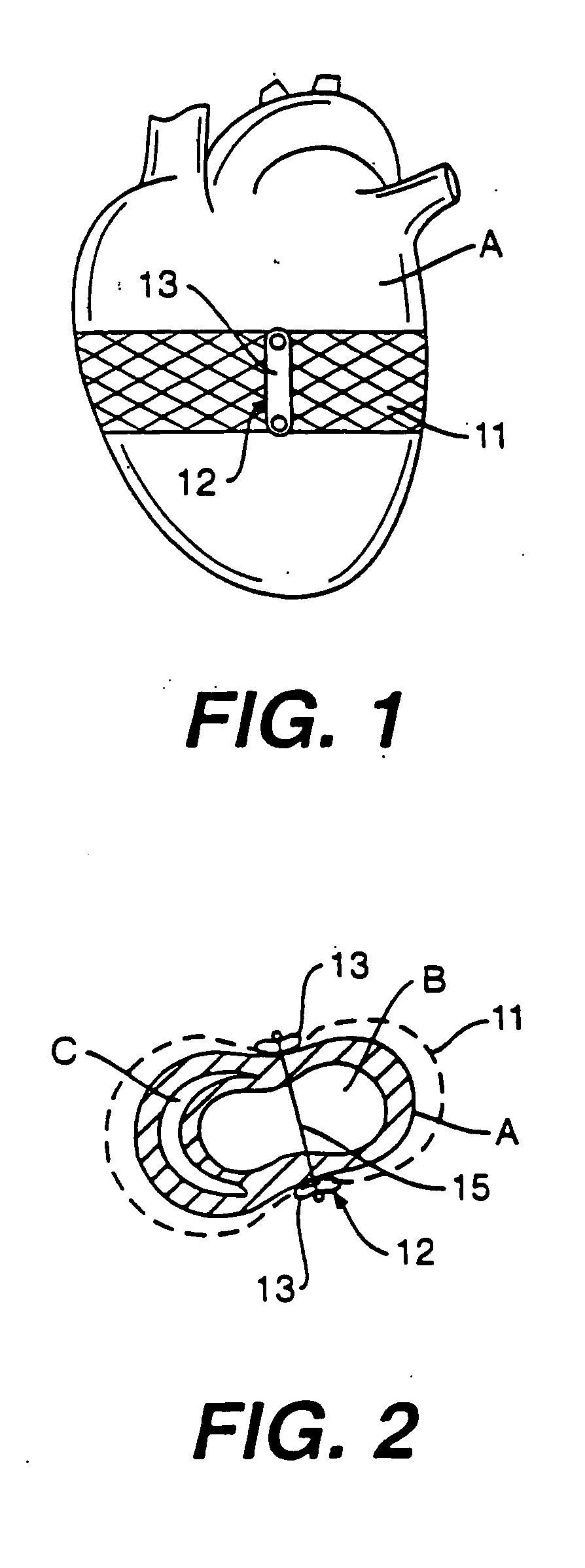 Stress reduction apparatus and method