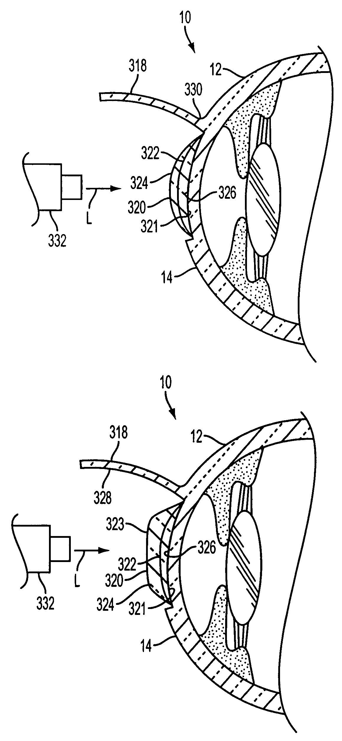 Adjustable inlay with multizone polymerization