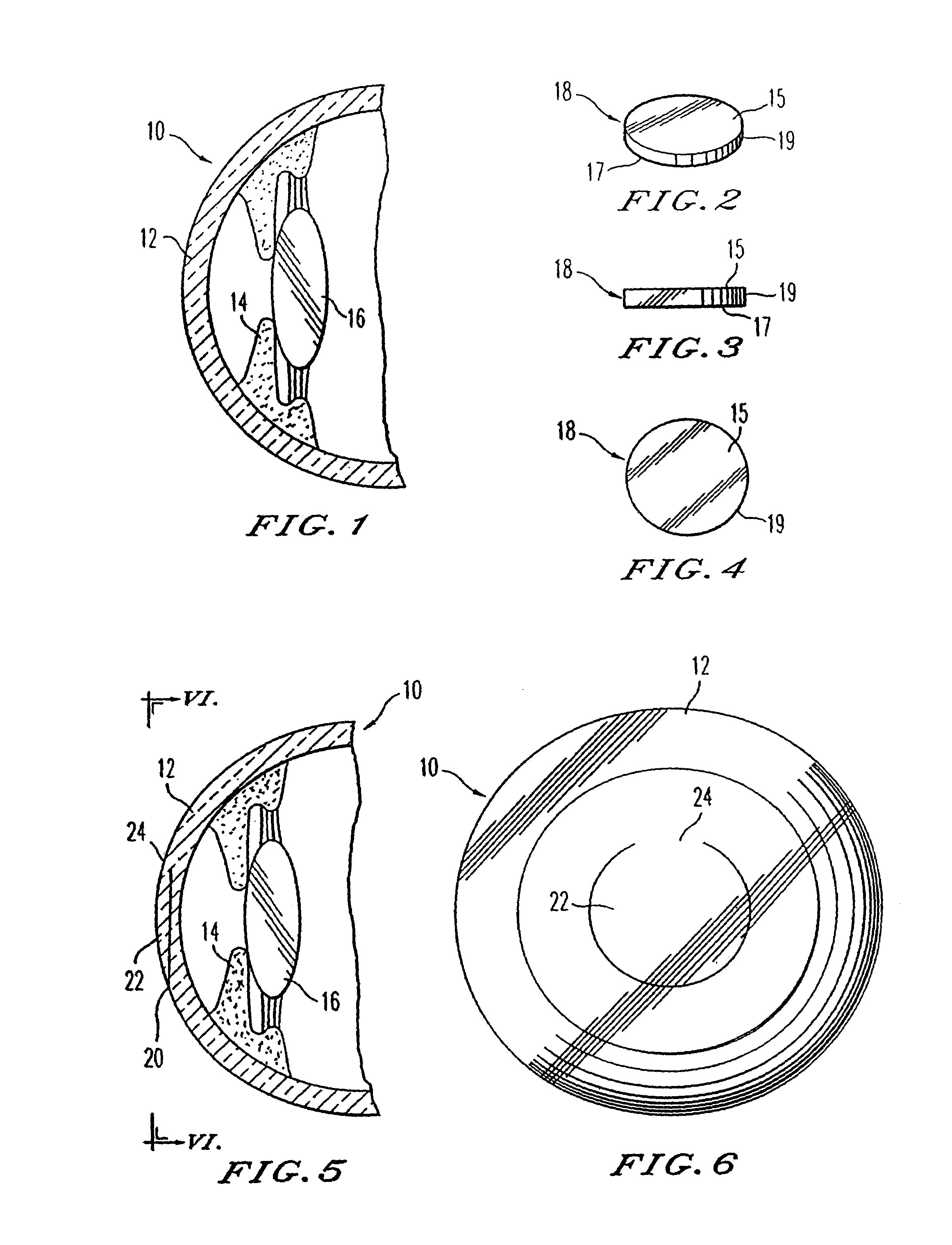 Adjustable inlay with multizone polymerization