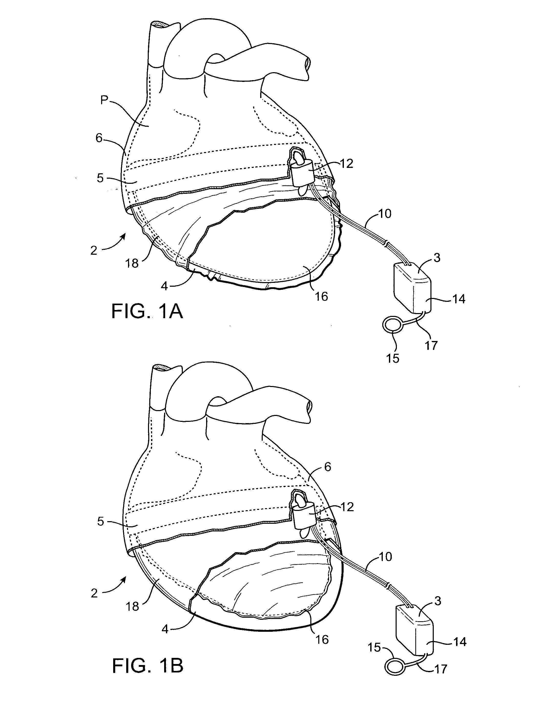 Devices and methods for providing cardiac assistance