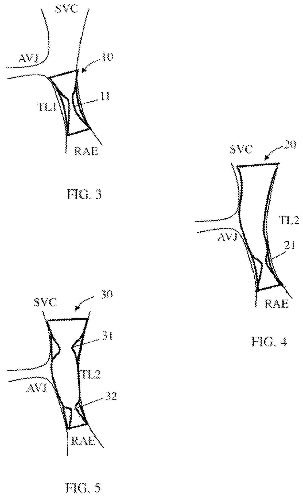 Controlling rate of blood flow to right atrium