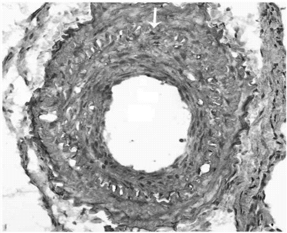 Drug coating stent based on HIV protease inhibitor saquinavir as well as preparation method and application thereof